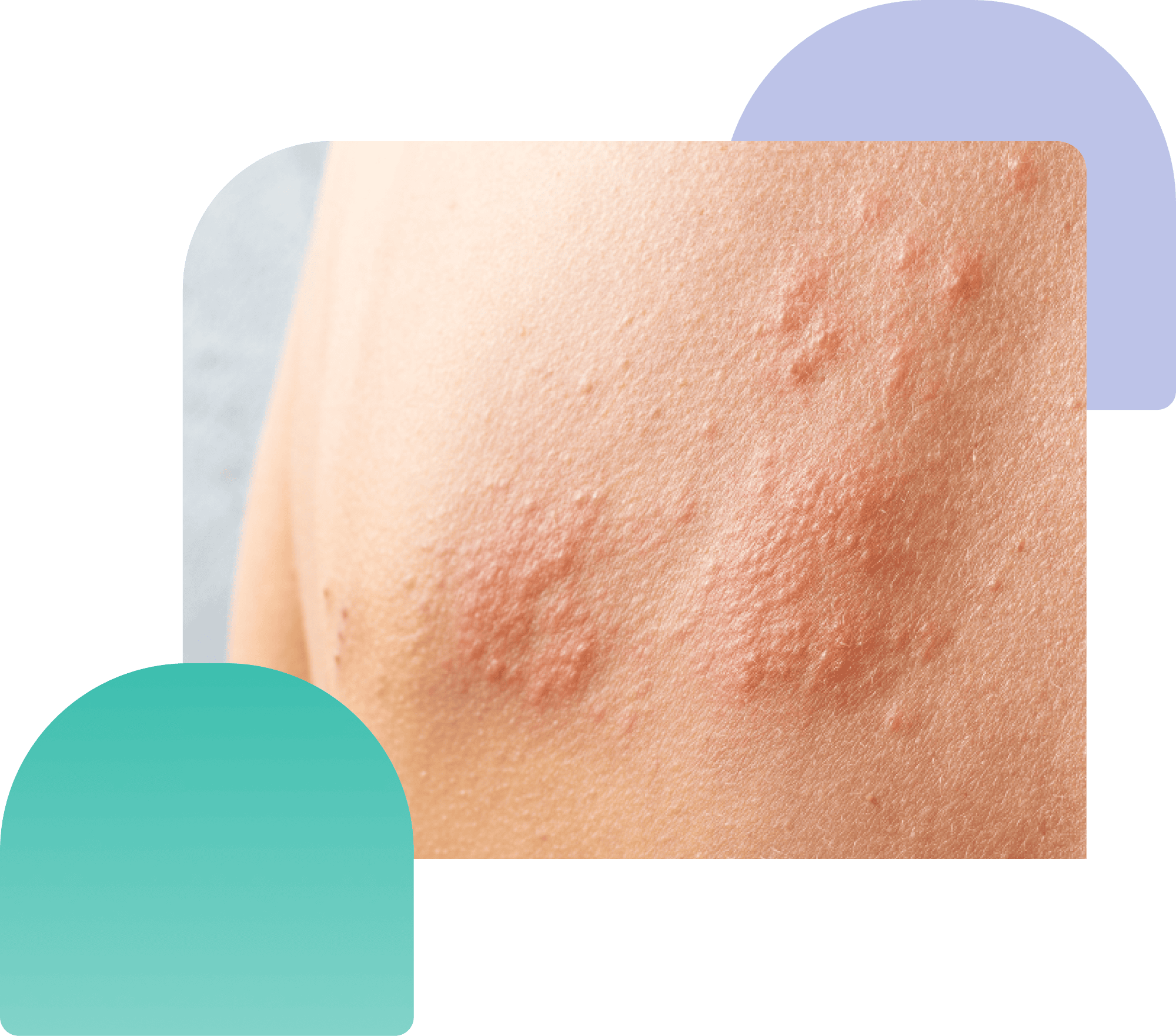 herpes zoster skin condition