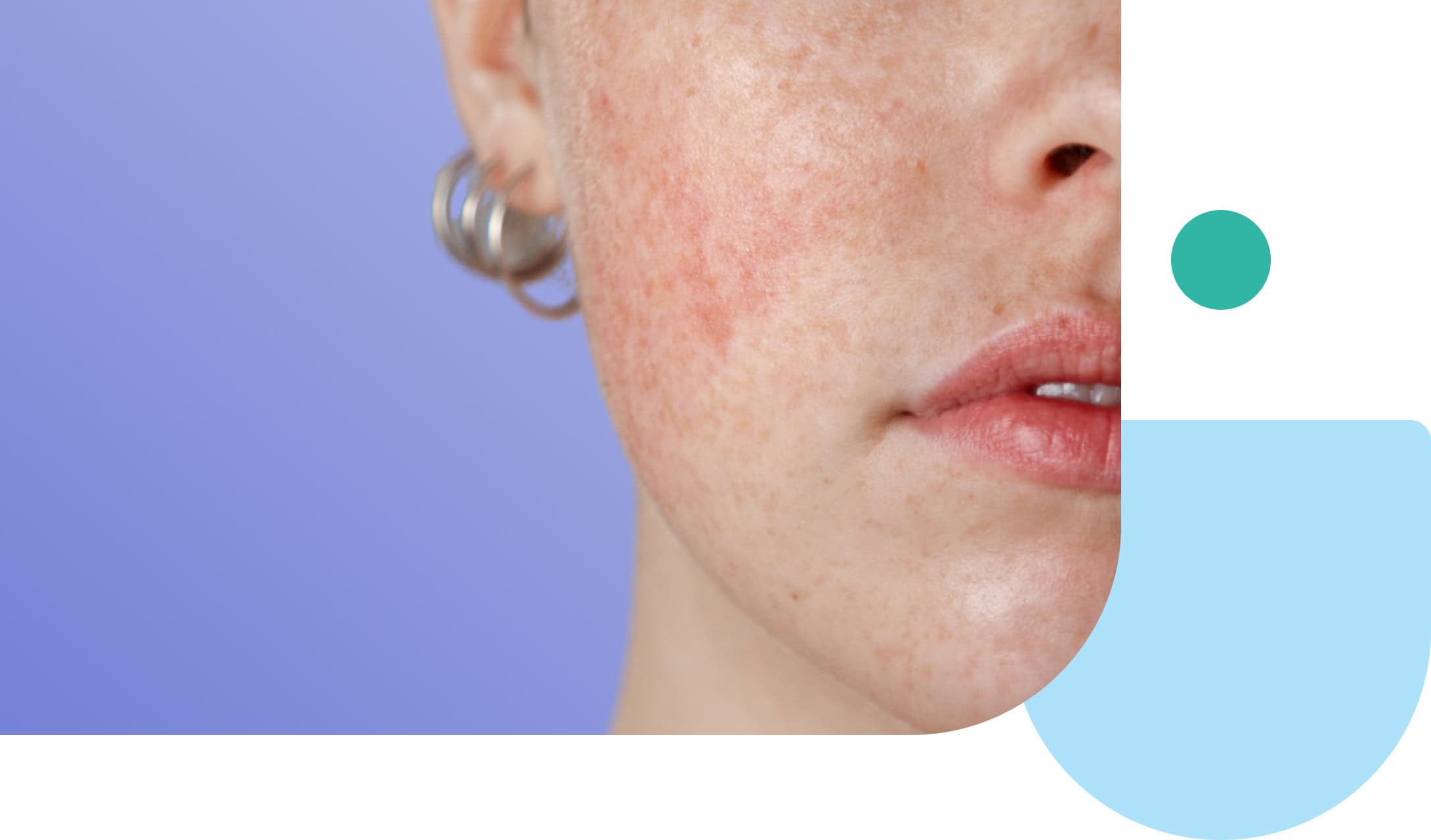 woman with rosacea on the face