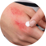 wound healing on skin