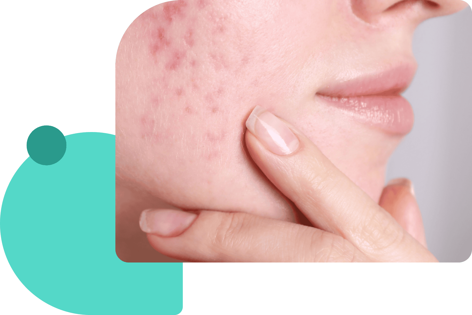 Clinically proven rosacea treatment options Dermatologist-recommended evidence-based treatment for rosacea flare-ups
