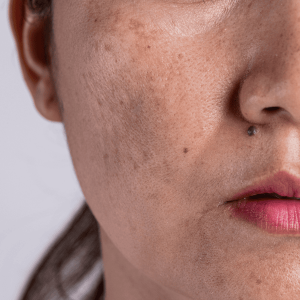 hyperpigmentation hyperpigmentation
