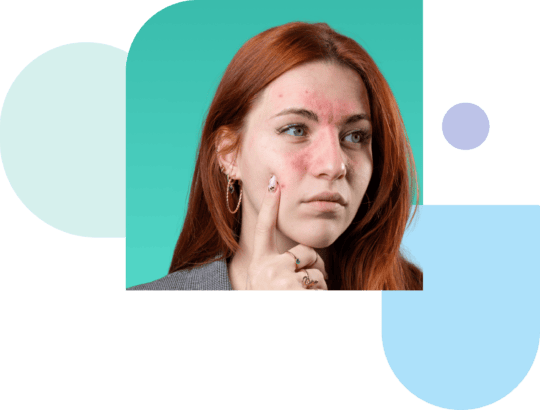 treatment for rosacea online
