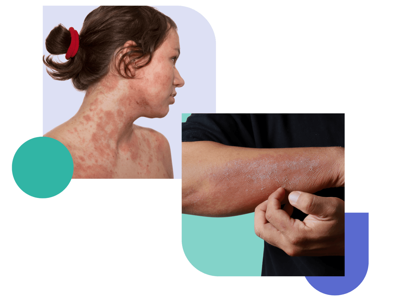 Dyshidrotic Eczema (Pompholyx) Treatment Cream Options