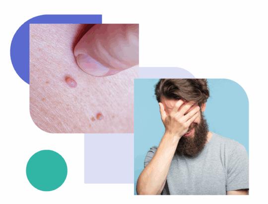 Close-up of genital warts on skin and a man covering his face with his hand, representing the physical symptoms and emotional impact of genital warts.