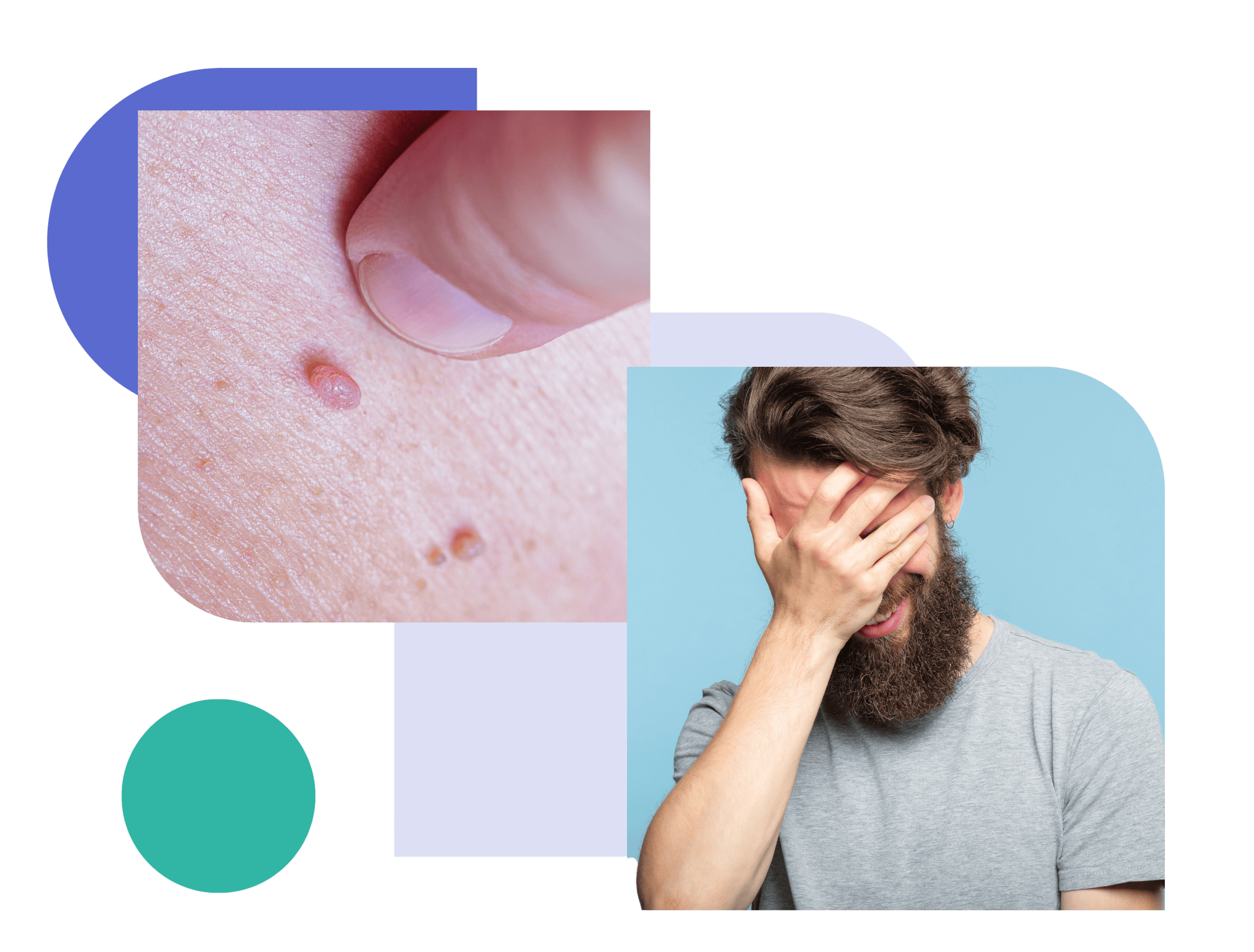 Close-up of genital warts on skin and a man covering his face with his hand, representing the physical symptoms and emotional impact of genital warts.