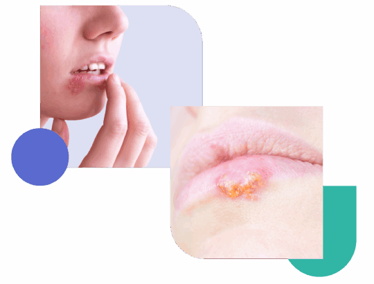 Close-up of cold sore on lip, a person is touching herpes simplex virus outbreak (HSV-1) with inflamed and crusted blisters