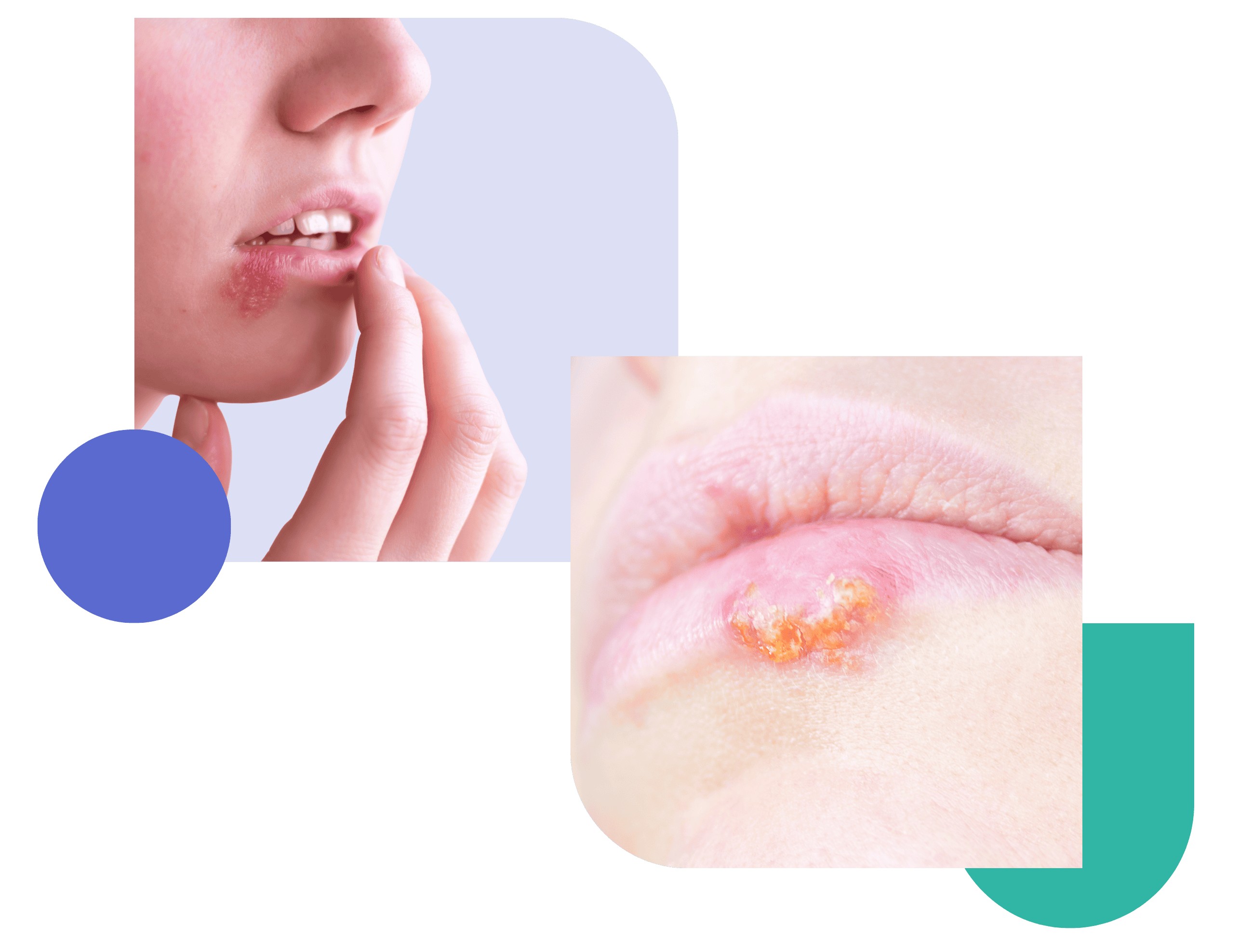 herpes treatment Close-up of cold sore on lip, a person is touching herpes simplex virus outbreak (HSV-1) with inflamed and crusted blisters