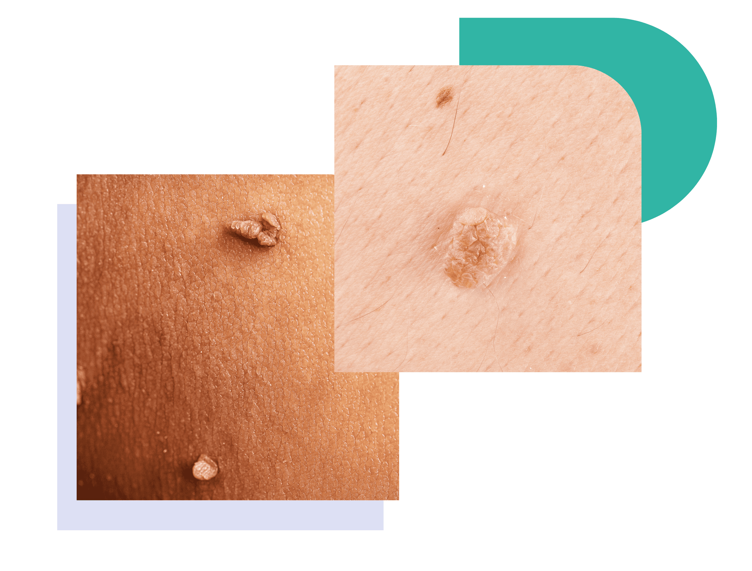 Genital Warts Treatment Online By Dermatologist Genital Warts Treatment Online By Dermatologist