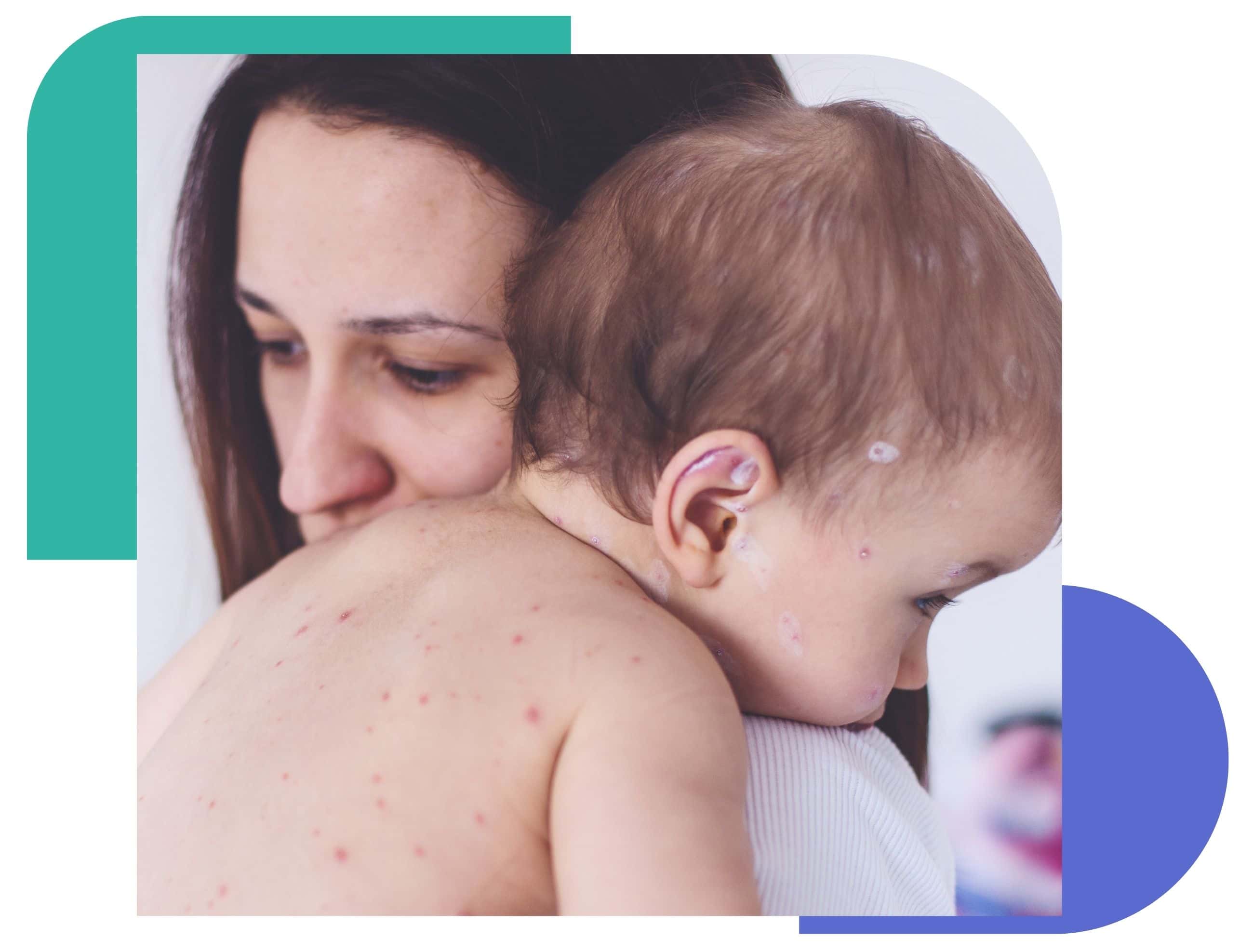 Mother holding a baby with visible red spots and skin irritation on the back and head, illustrating pediatric skin conditions that can be evaluated through Miiskin’s online dermatology care