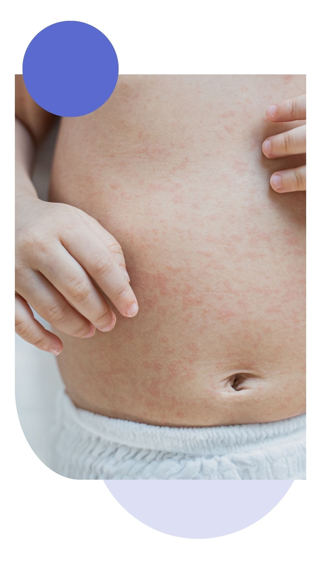 Close-up of a baby’s abdomen showing red, patchy rash and irritation on the skin. The image illustrates common infant skin conditions such as eczema or heat rash.