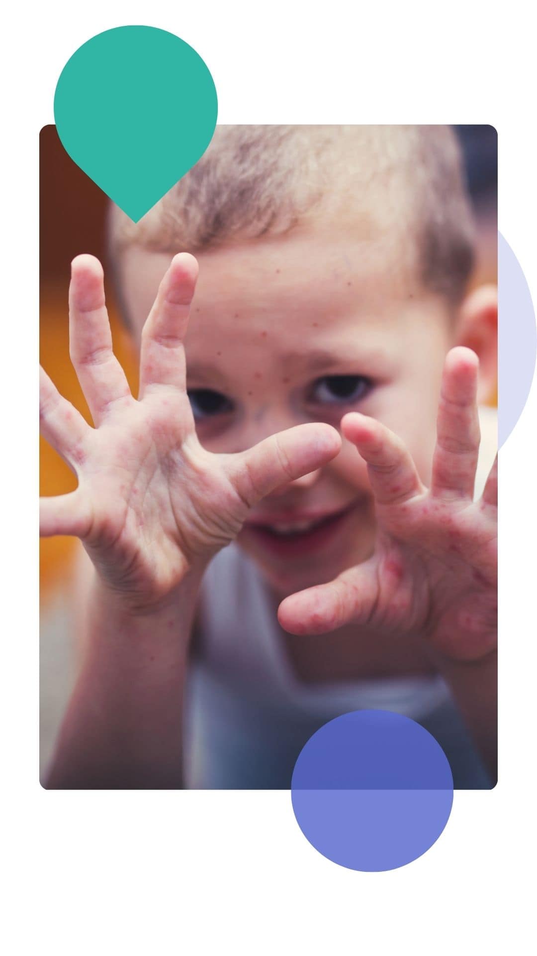 A young child showing their hands covered with small red spots and rashes, illustrating common childhood skin issues that can be assessed through Miiskin’s online dermatology care.