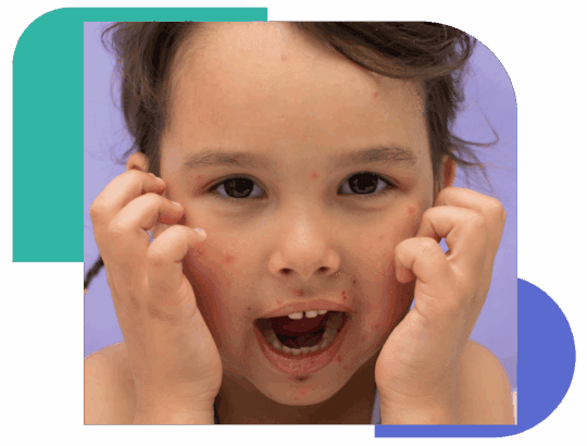 A young child with visible red spots and rashes on their face, scratching their cheeks. The image illustrates common pediatric skin conditions that may require dermatology care.