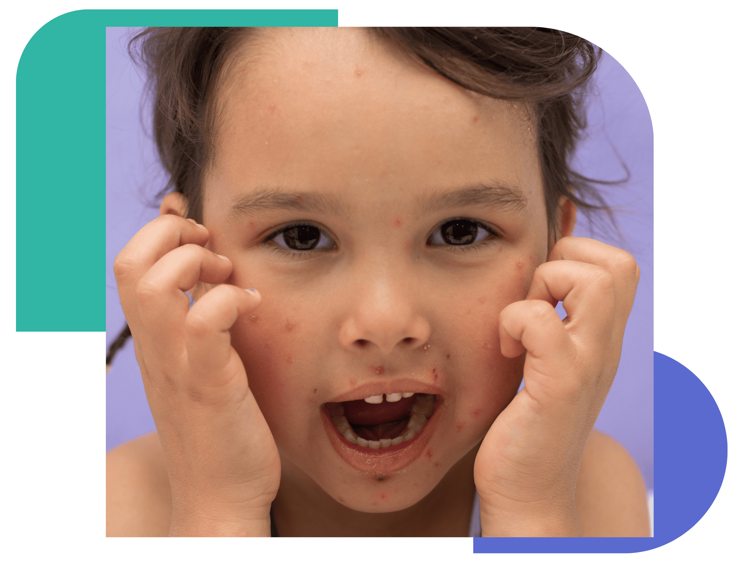 A young child with visible red spots and rashes on their face, scratching their cheeks. The image illustrates common pediatric skin conditions that may require dermatology care.