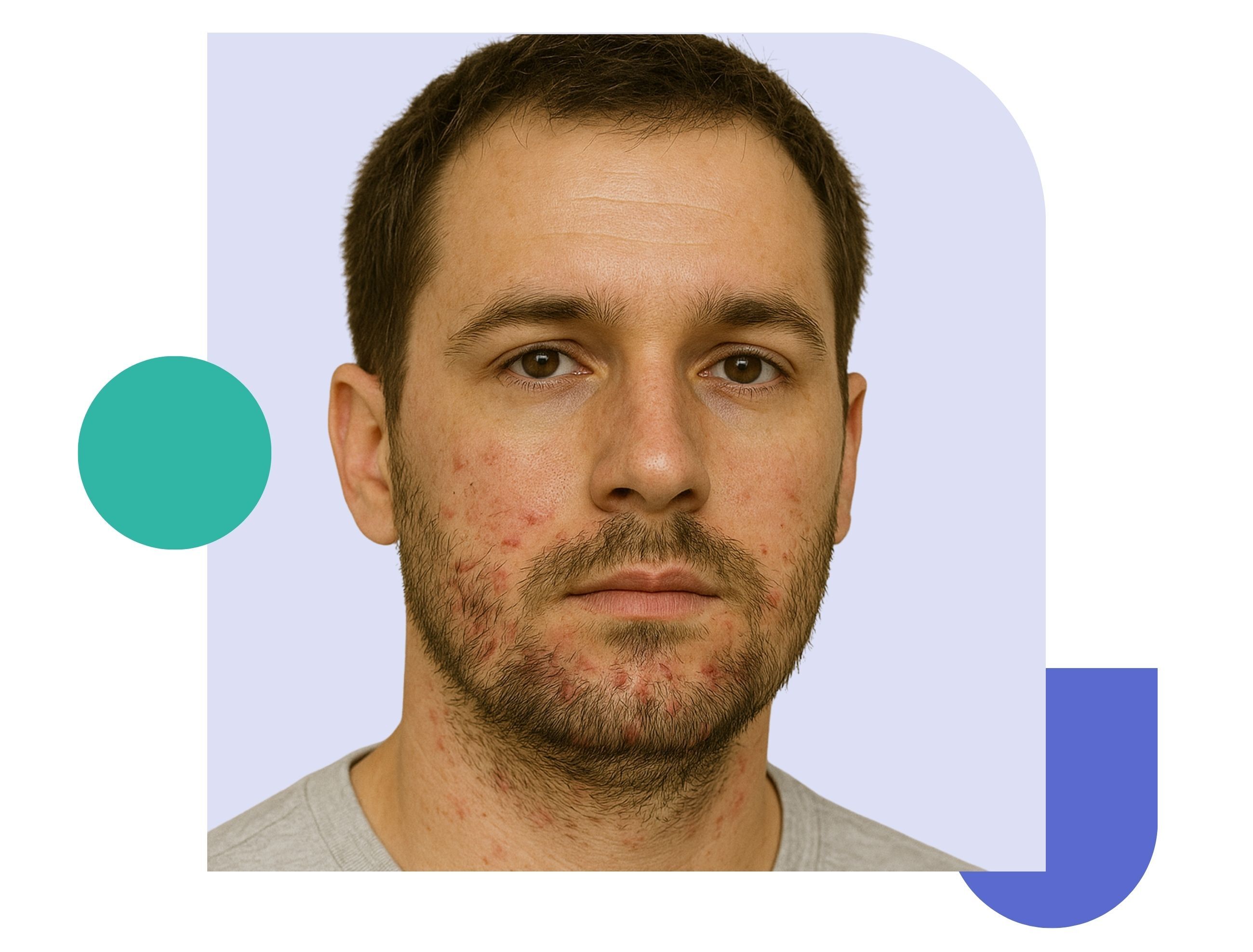 follicutilitis in men folliculitis on man's face