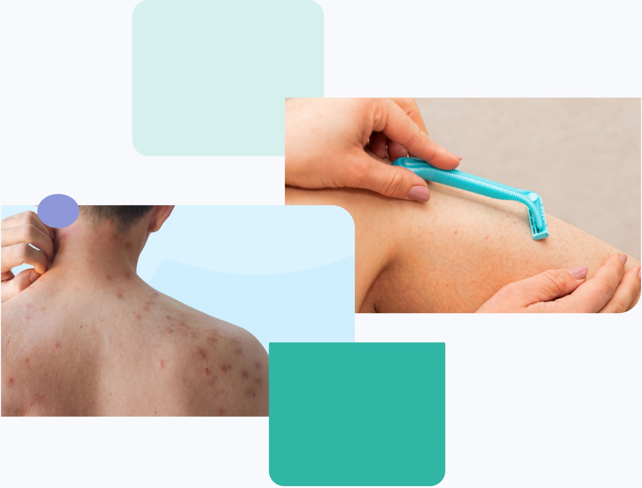 folliculitis treatment via online consultations image showing folliculitin on man's back and woman's leg after shawing