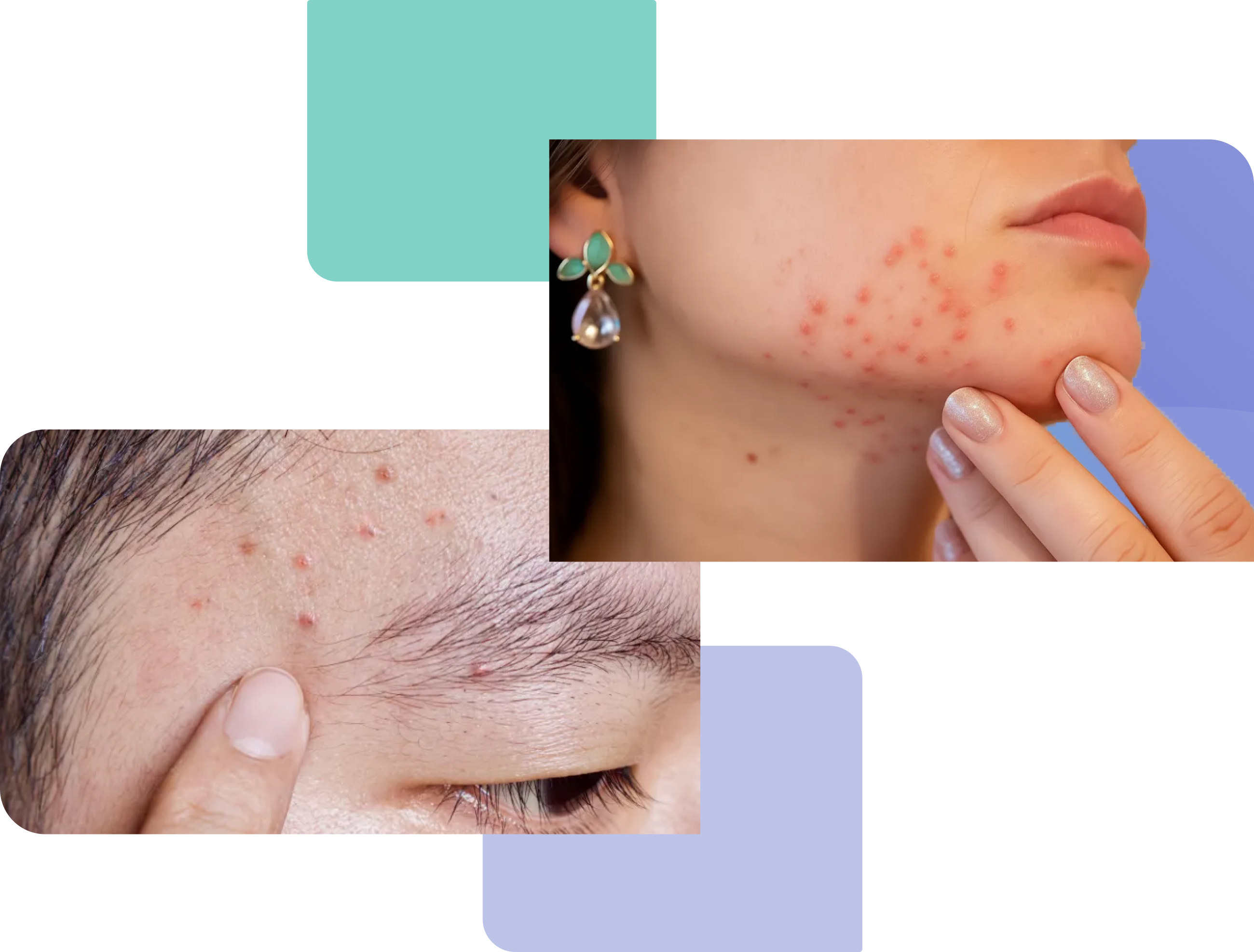 folliculitis on skin treatment online image showing folliculitis on woman's neck and man's forehead