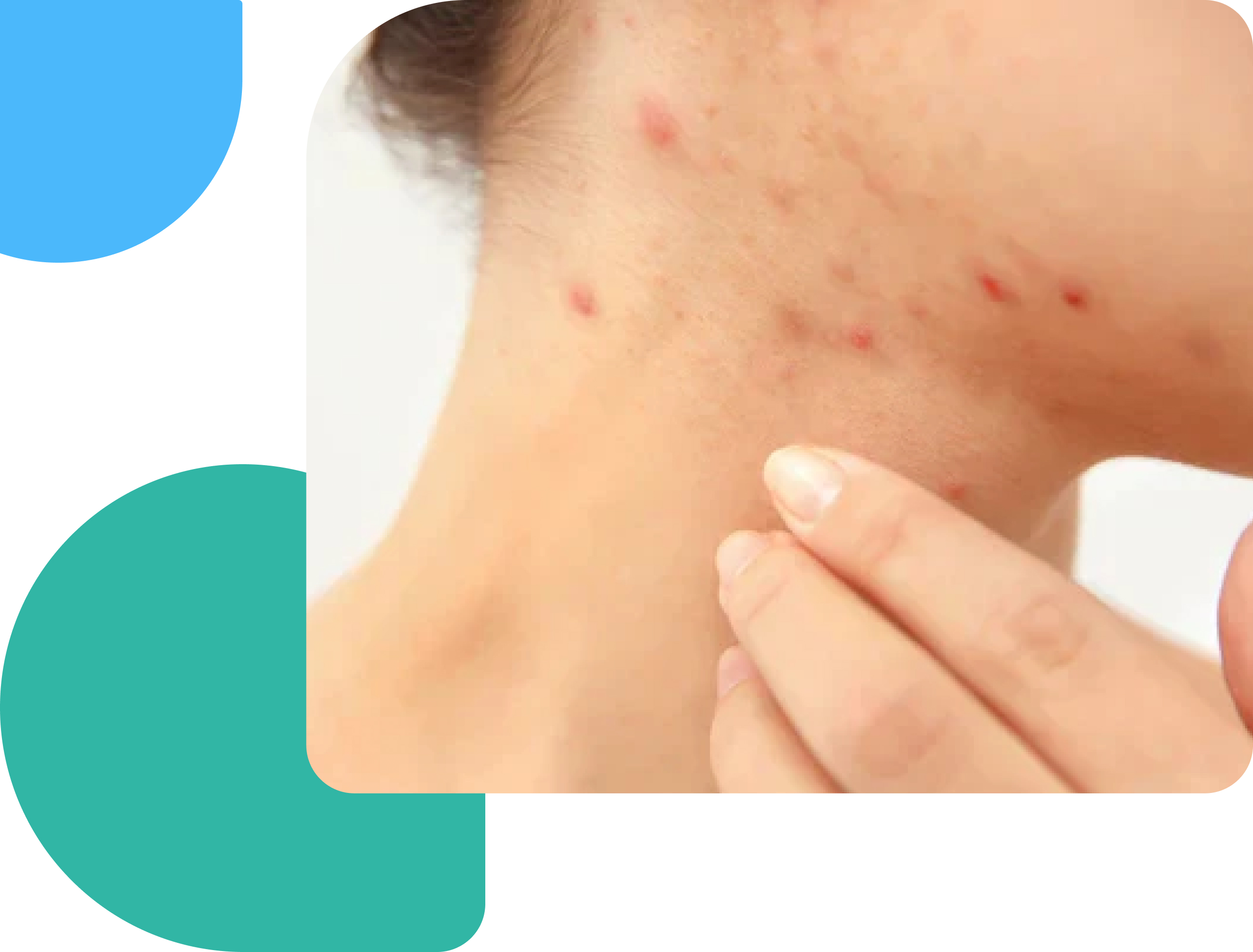 treat folliculitis online image showing folliculitis on woman's neck