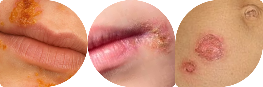3 images of different impetigo types