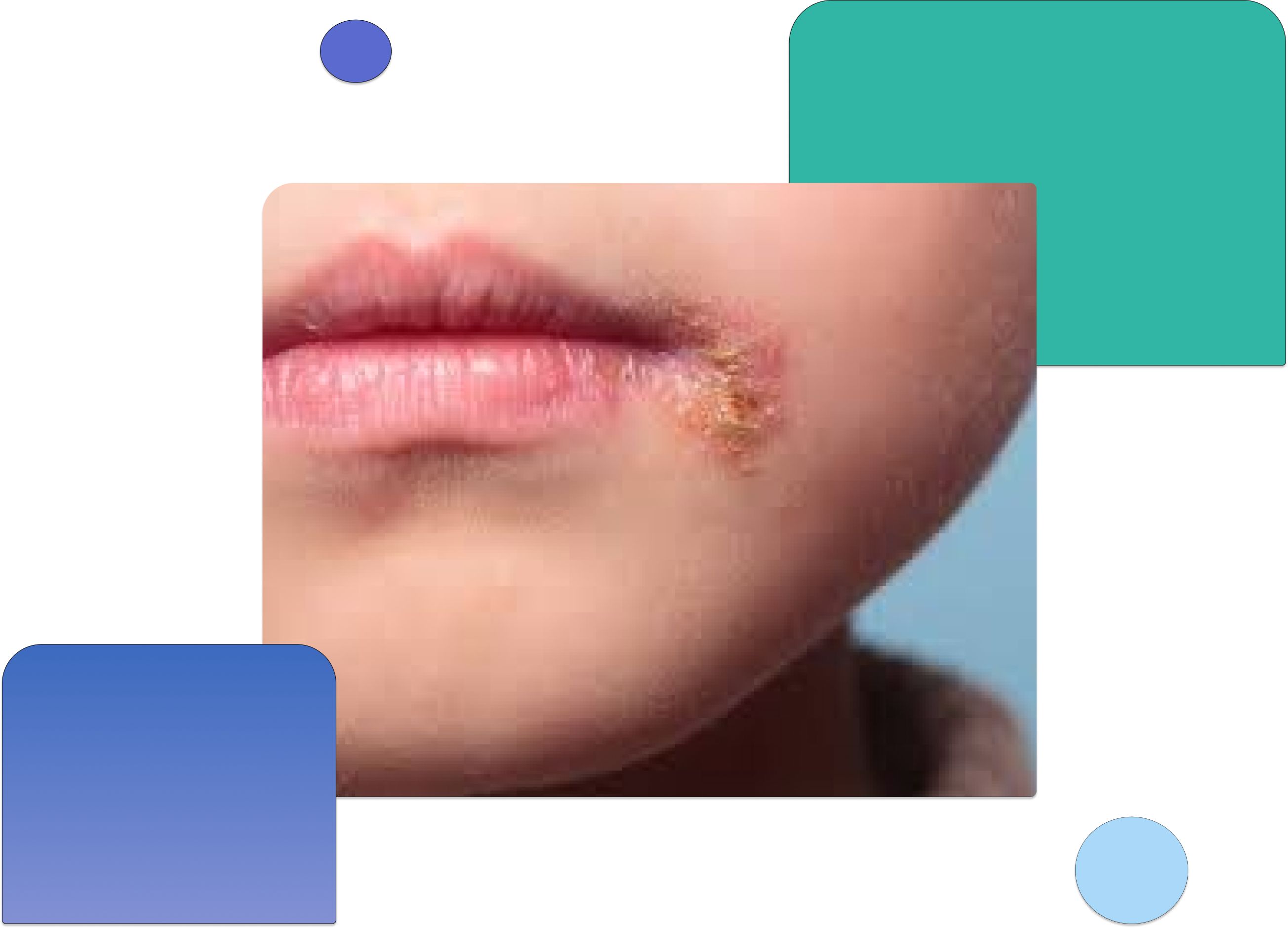 Child with impetigo showing a yellow-crusted sore at the corner of the mouth, illustrating common symptoms of the bacterial skin infection