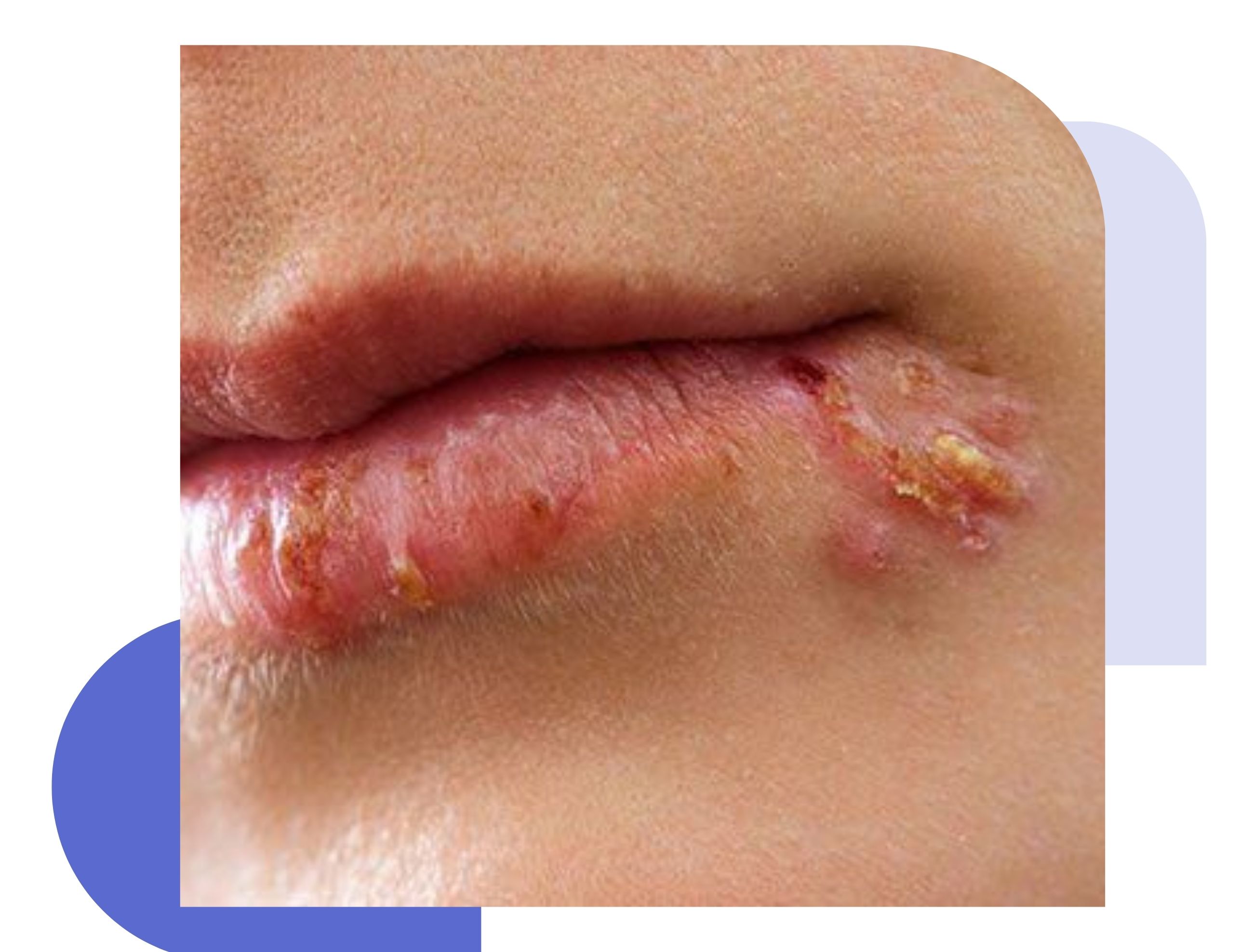 Child's mouth with impetigo showing a yellow-crusted sore at the corner of the mouth, illustrating common symptoms of the bacterial skin infection