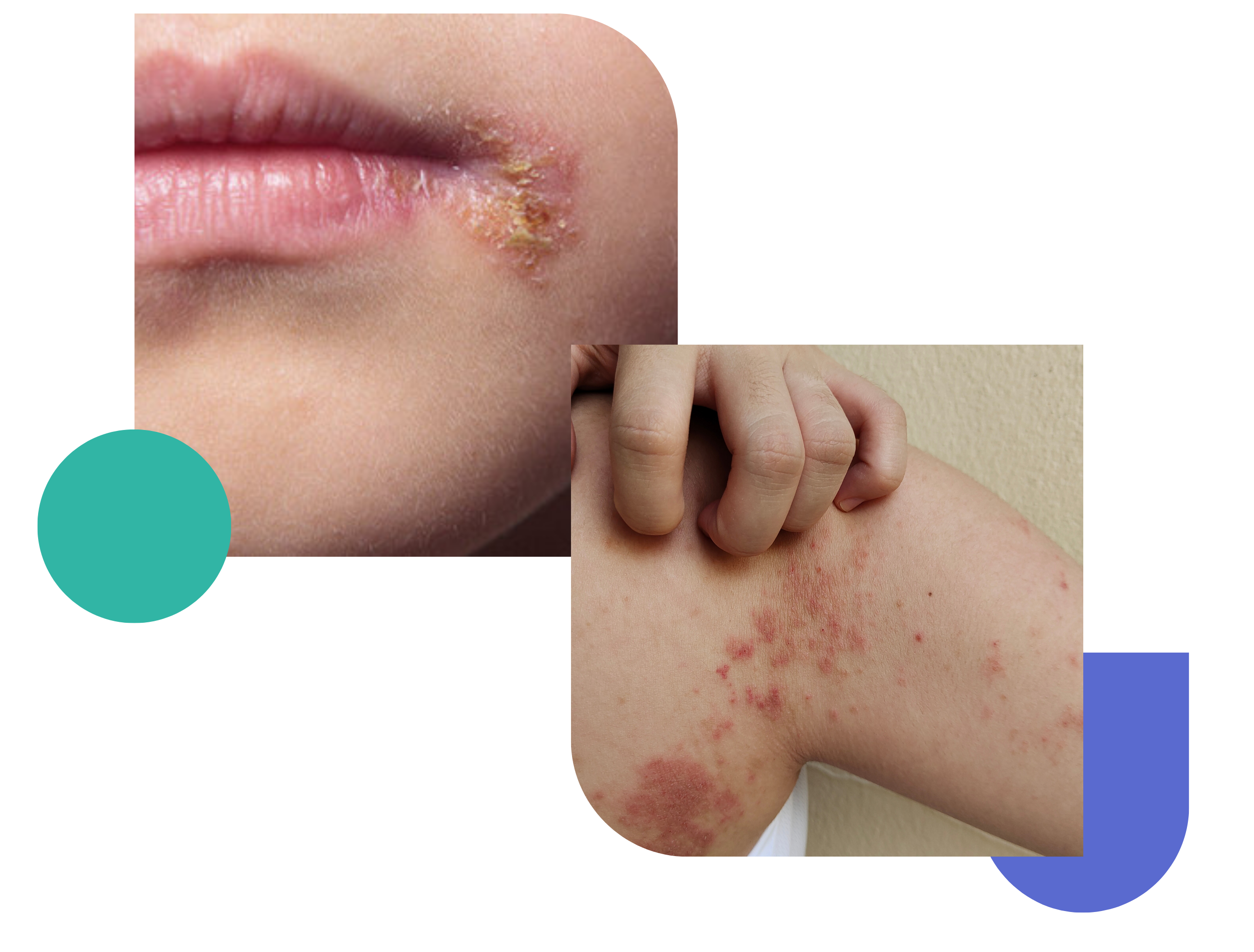 treatment of impetigo online