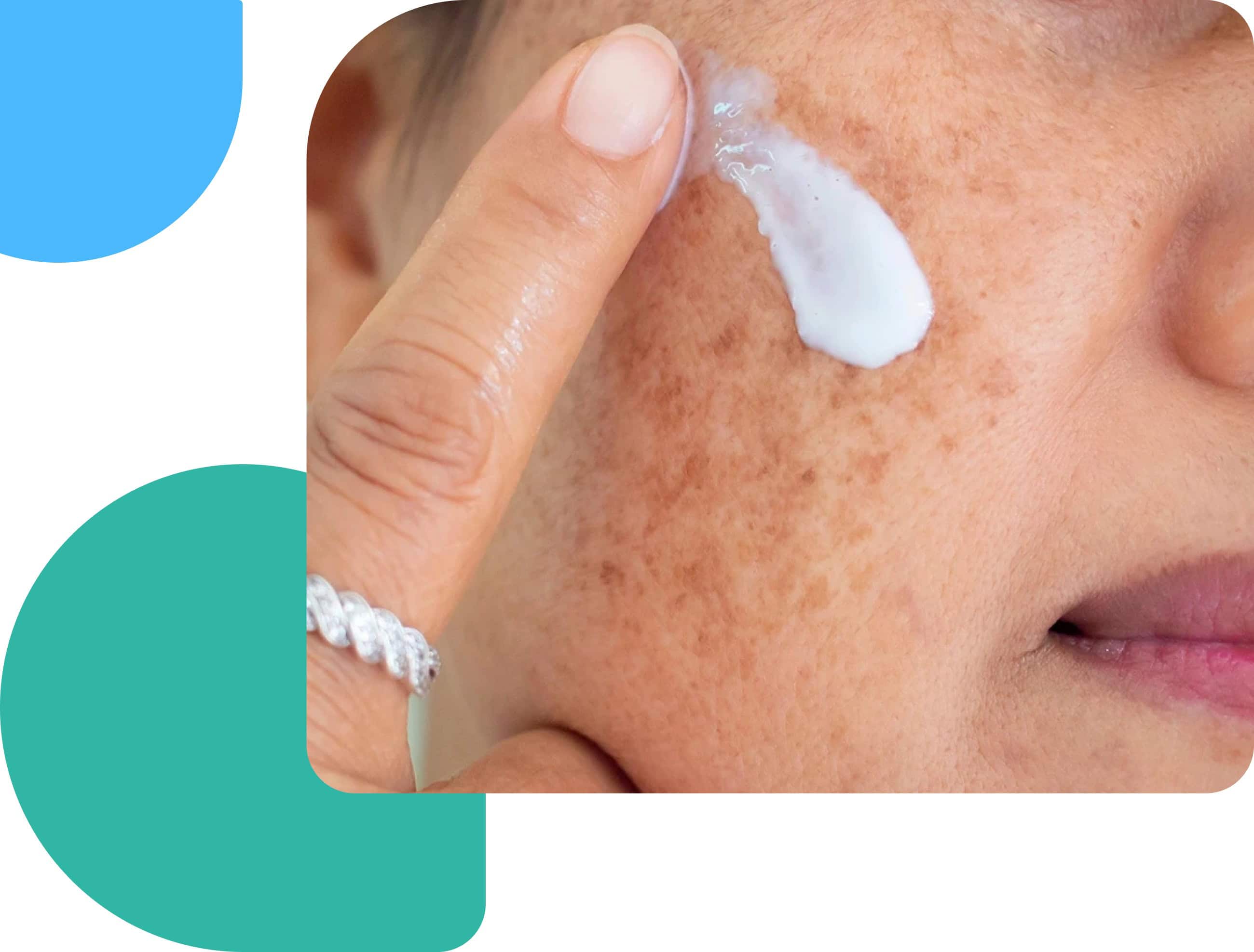 woman with melasma on the face putting a cream