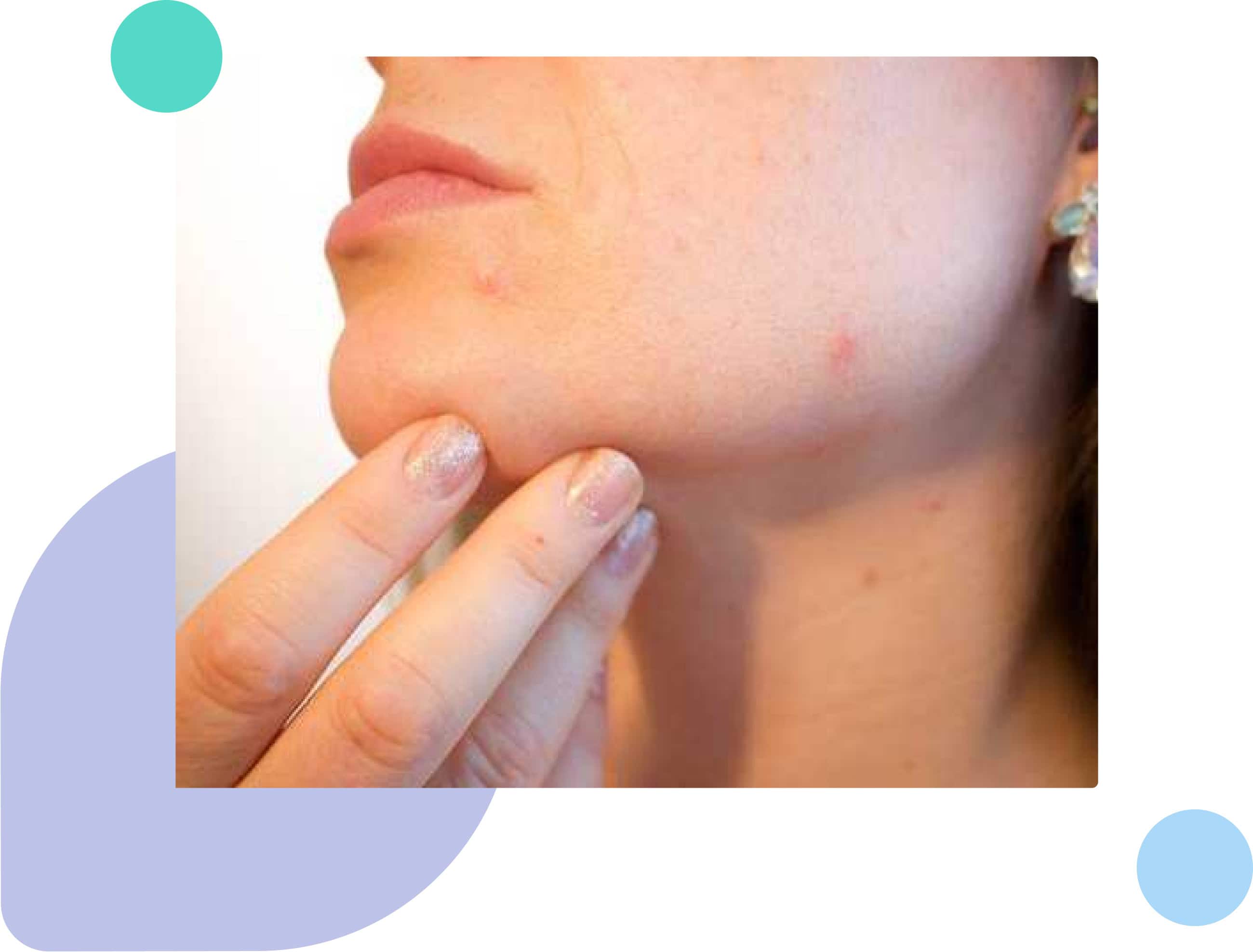 follicutilitis in women folliculitis on woman's face