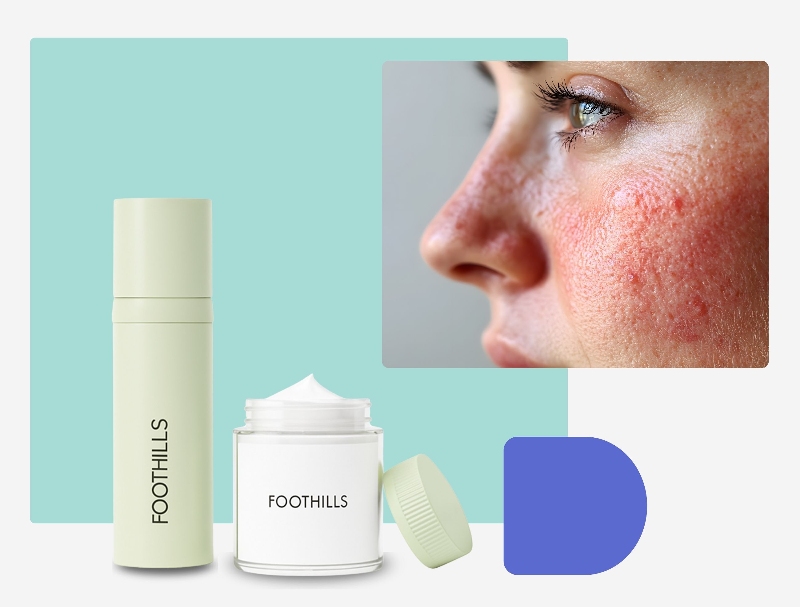 how to purchase metronidazole cream