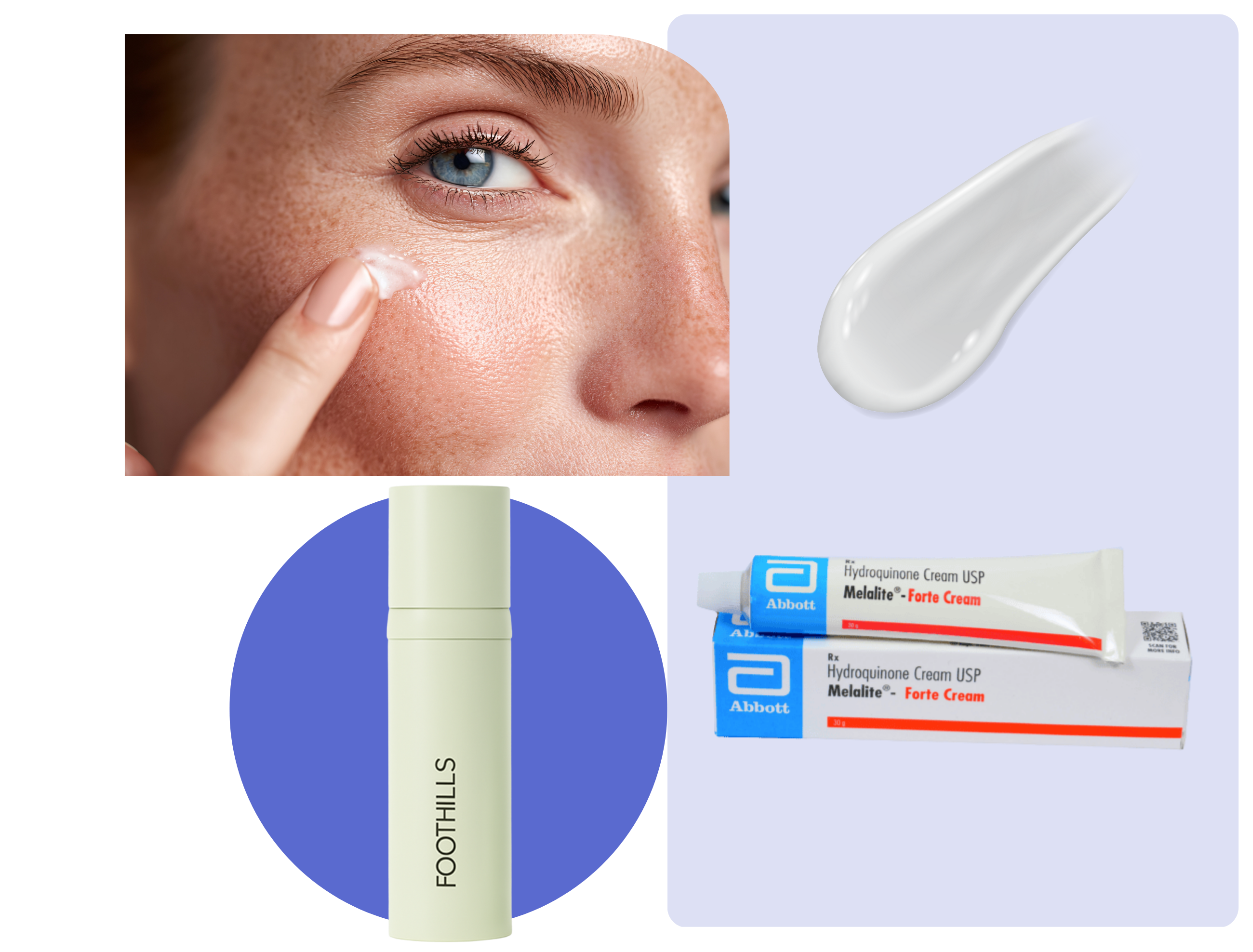 Hydroquinone cream for hyperpigmentation displayed with a woman applying skin treatment and a Foothills Pharmacy bottle.