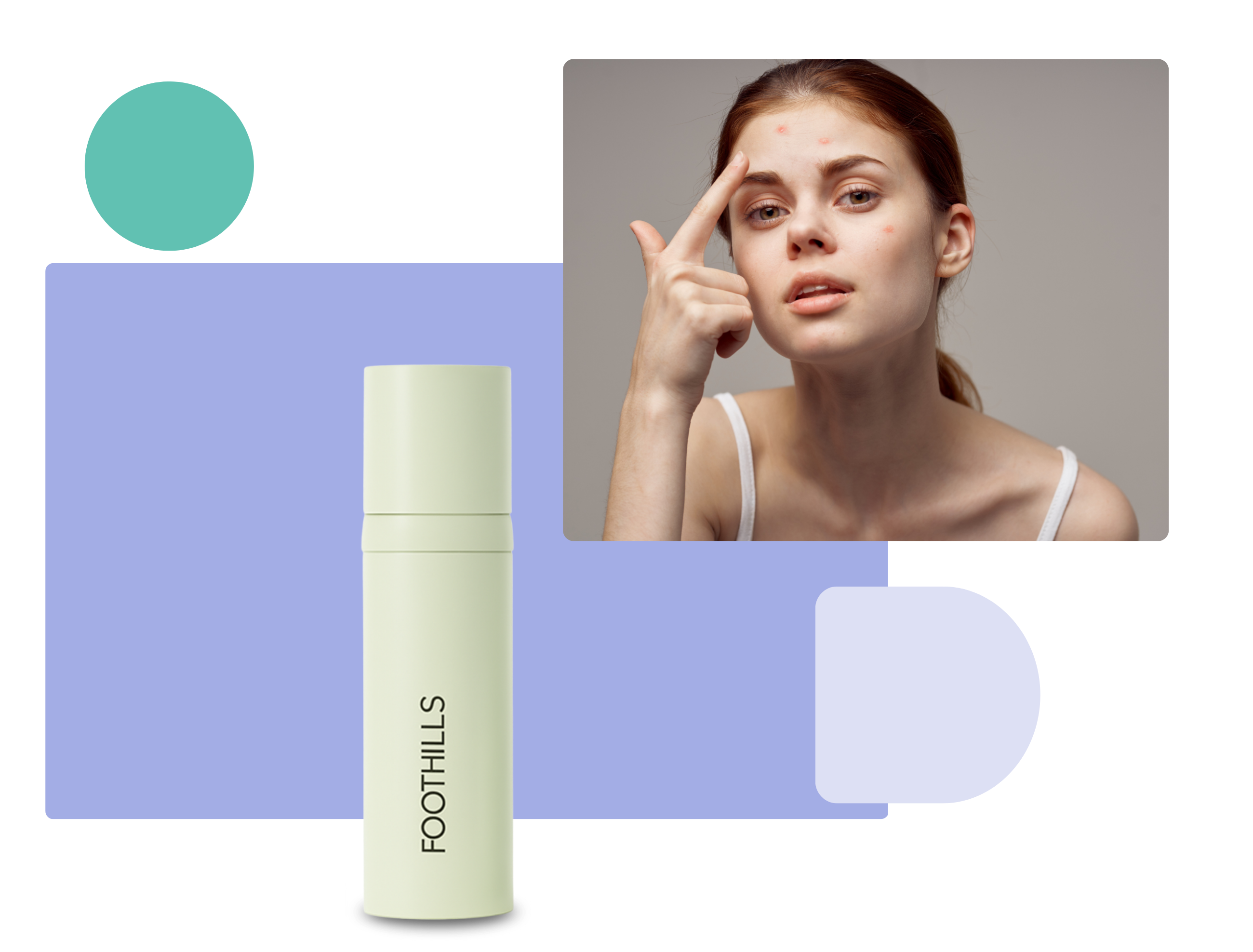 Woman with acne touching her forehead alongside a topical spironolactone gel and a Foothills Pharmacy skincare bottle
