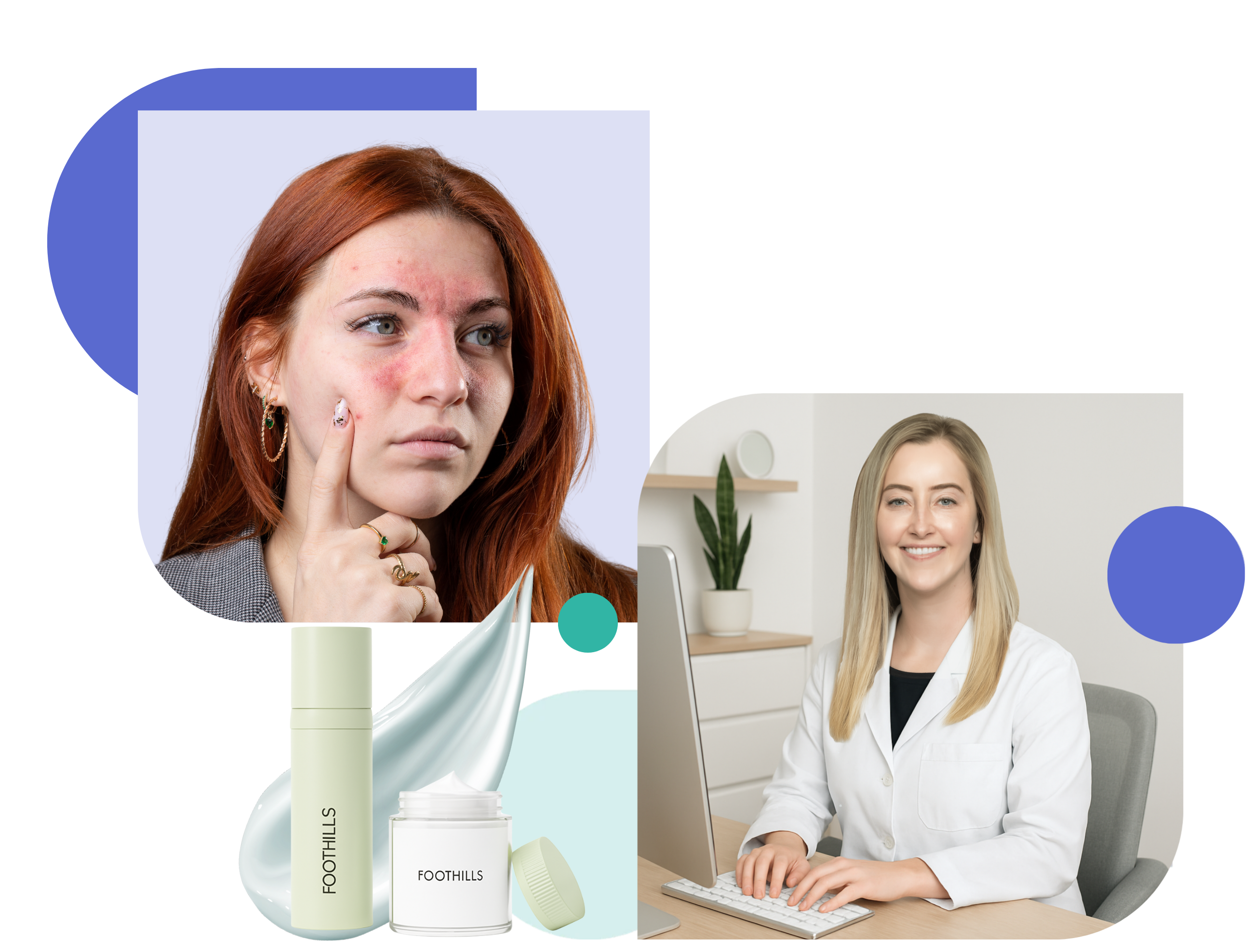 online rosacea prescription treatment treatment for rosacea online