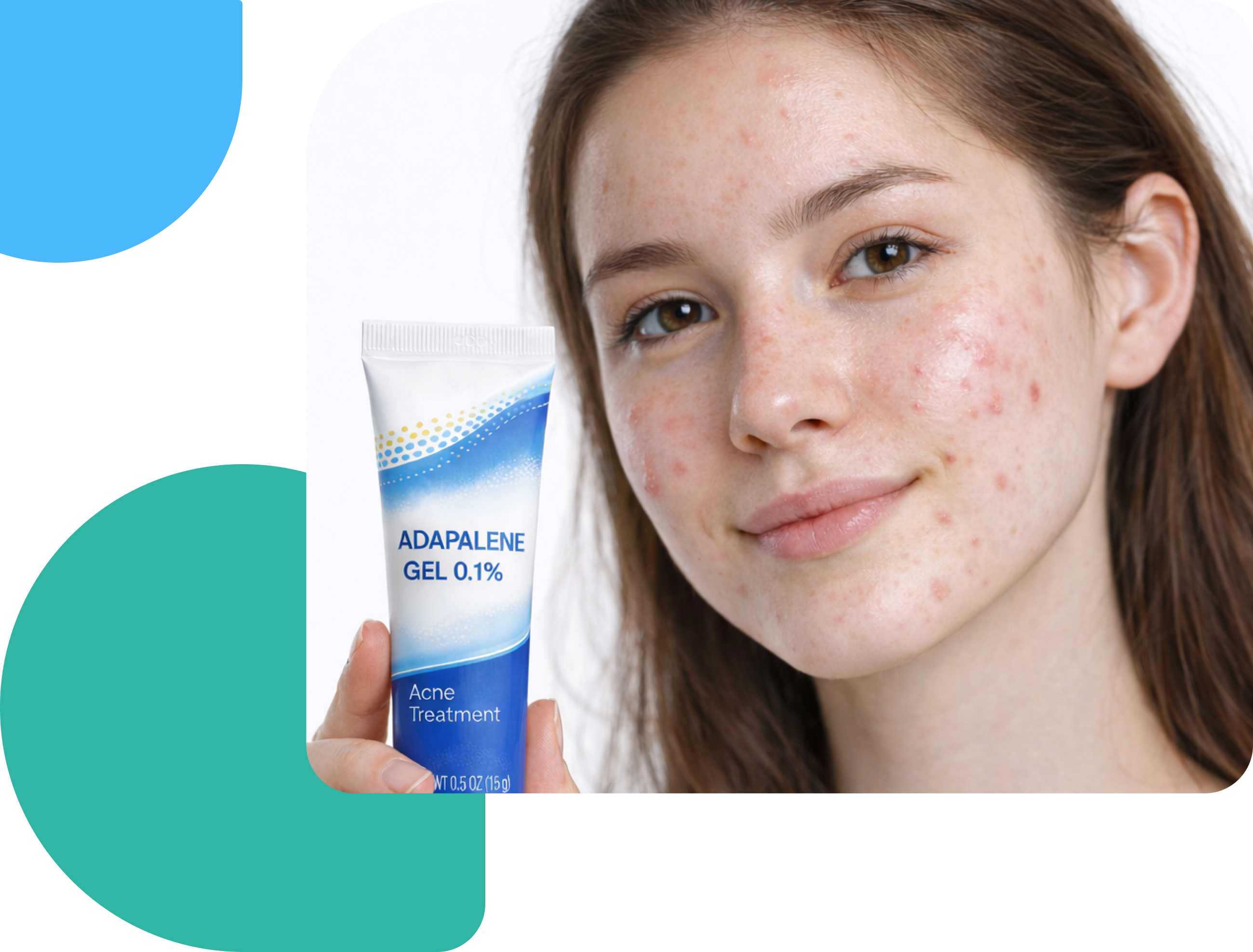 What is adapalene and how it is used for acne Young woman with acne-prone skin holding a tube of adapalene 0.1% gel.