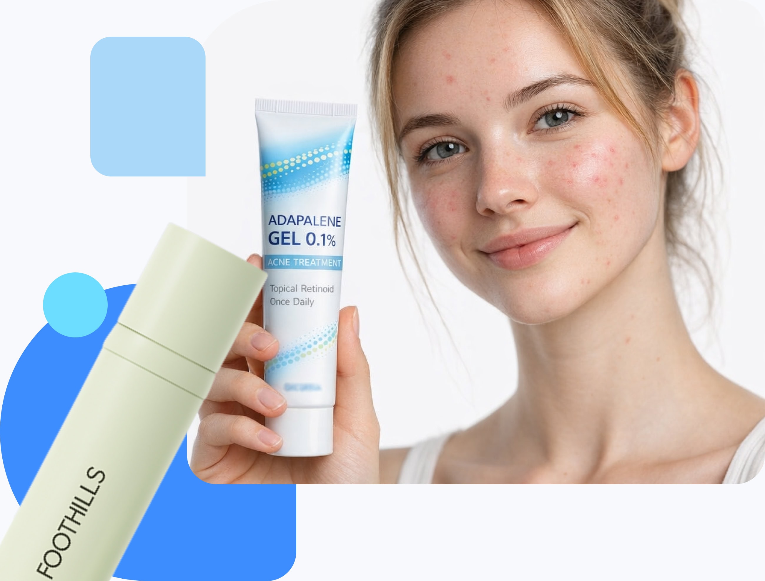 Adapalene 0.1% gel for acne treatment Young woman with mild acne holding a tube of adapalene 0.1% gel skincare treatment.