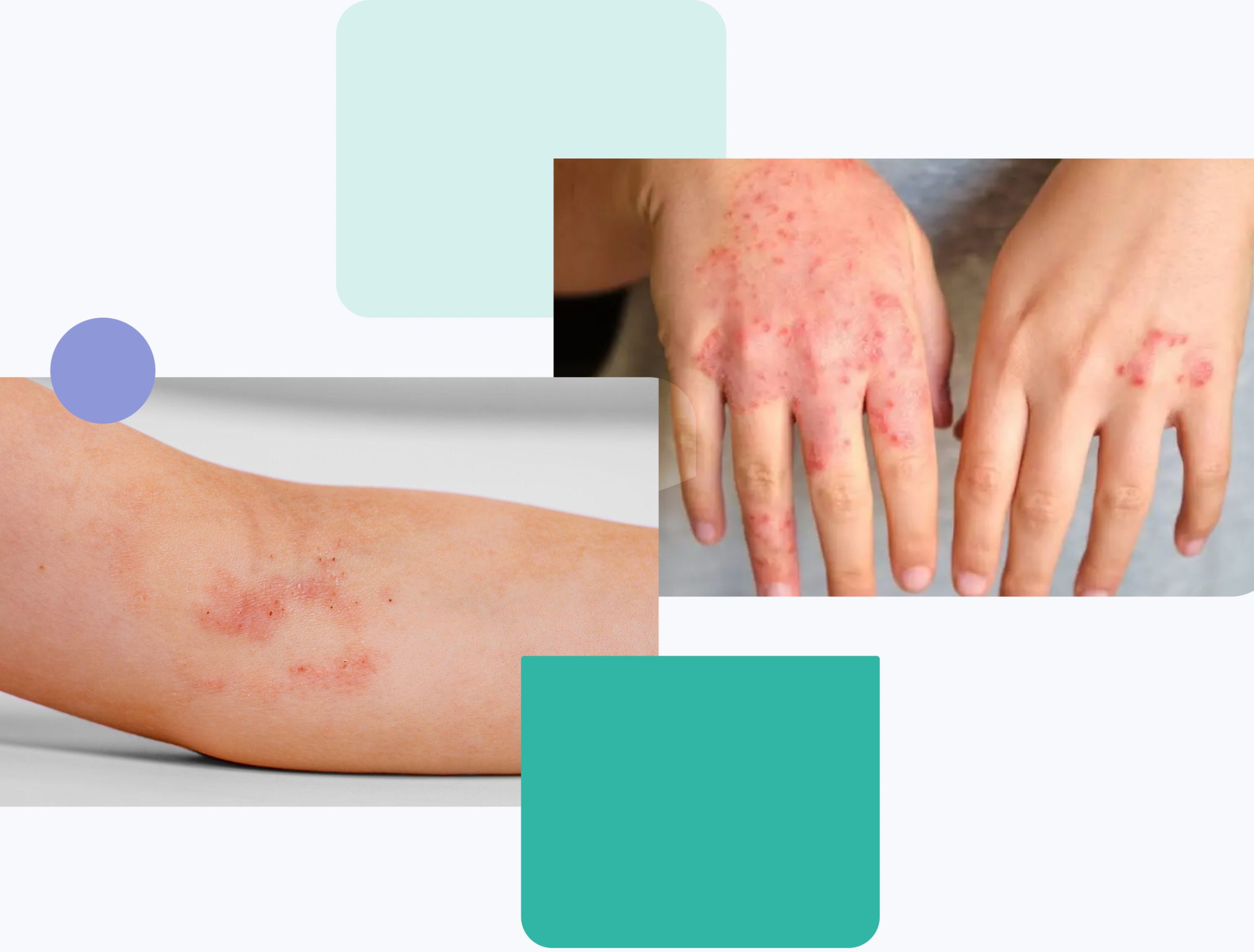 Collage showing atopic dermatitis symptoms on the skin, including red, inflamed, and irritated patches on the forearm and hands