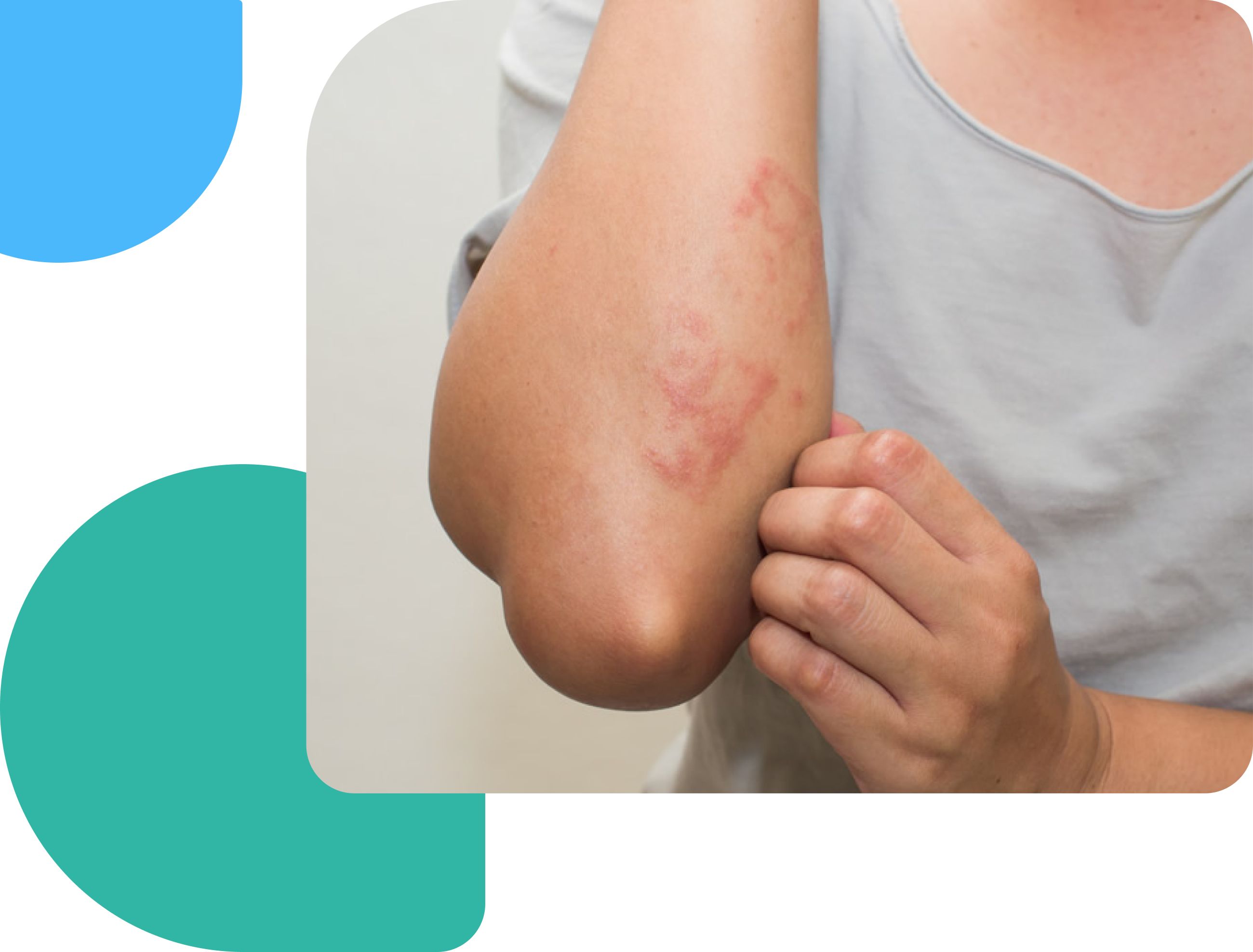 Atopic dermatitis on the elbow, showing red, inflamed patches of irritated skin.