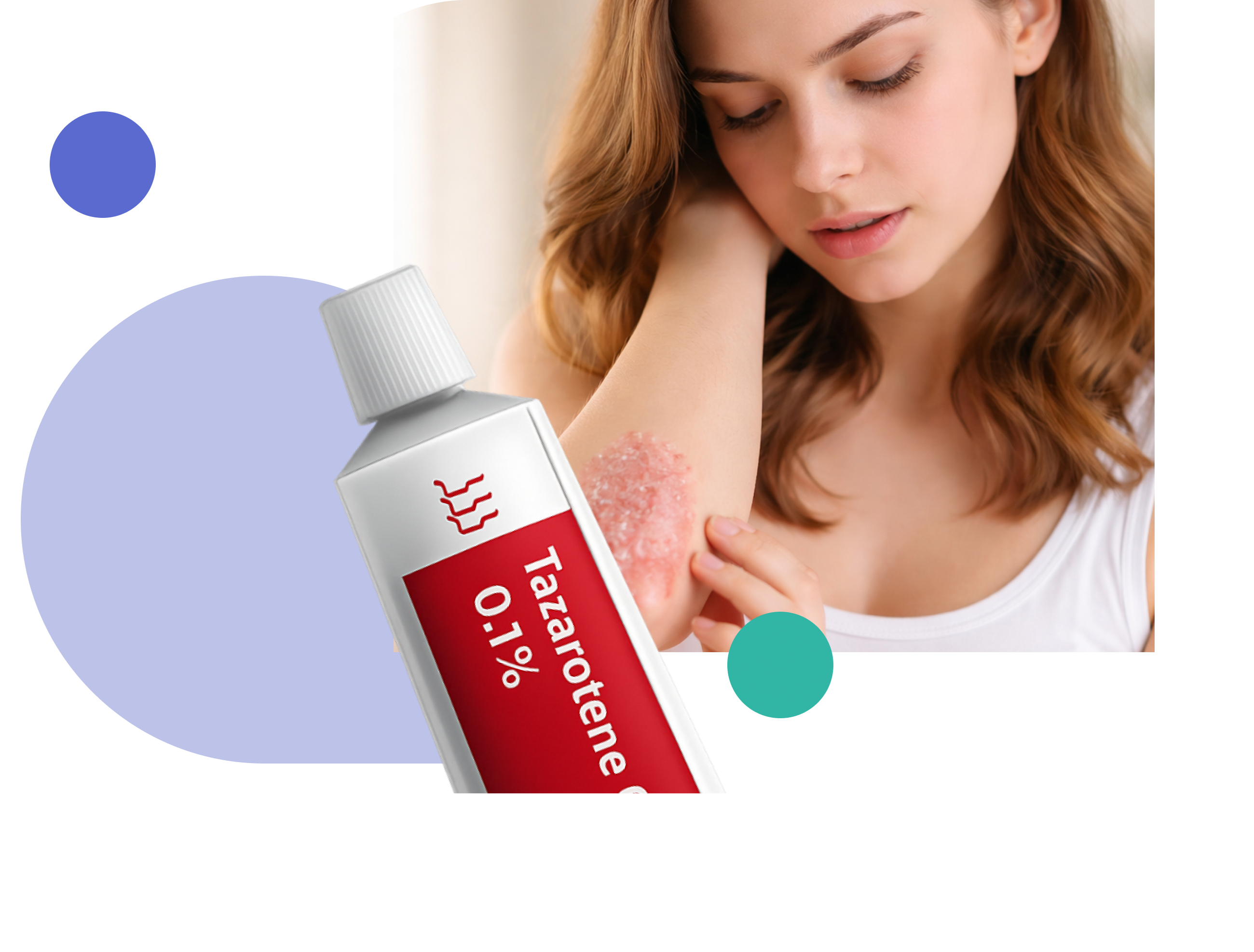 tazarotene and girl with psoriasis