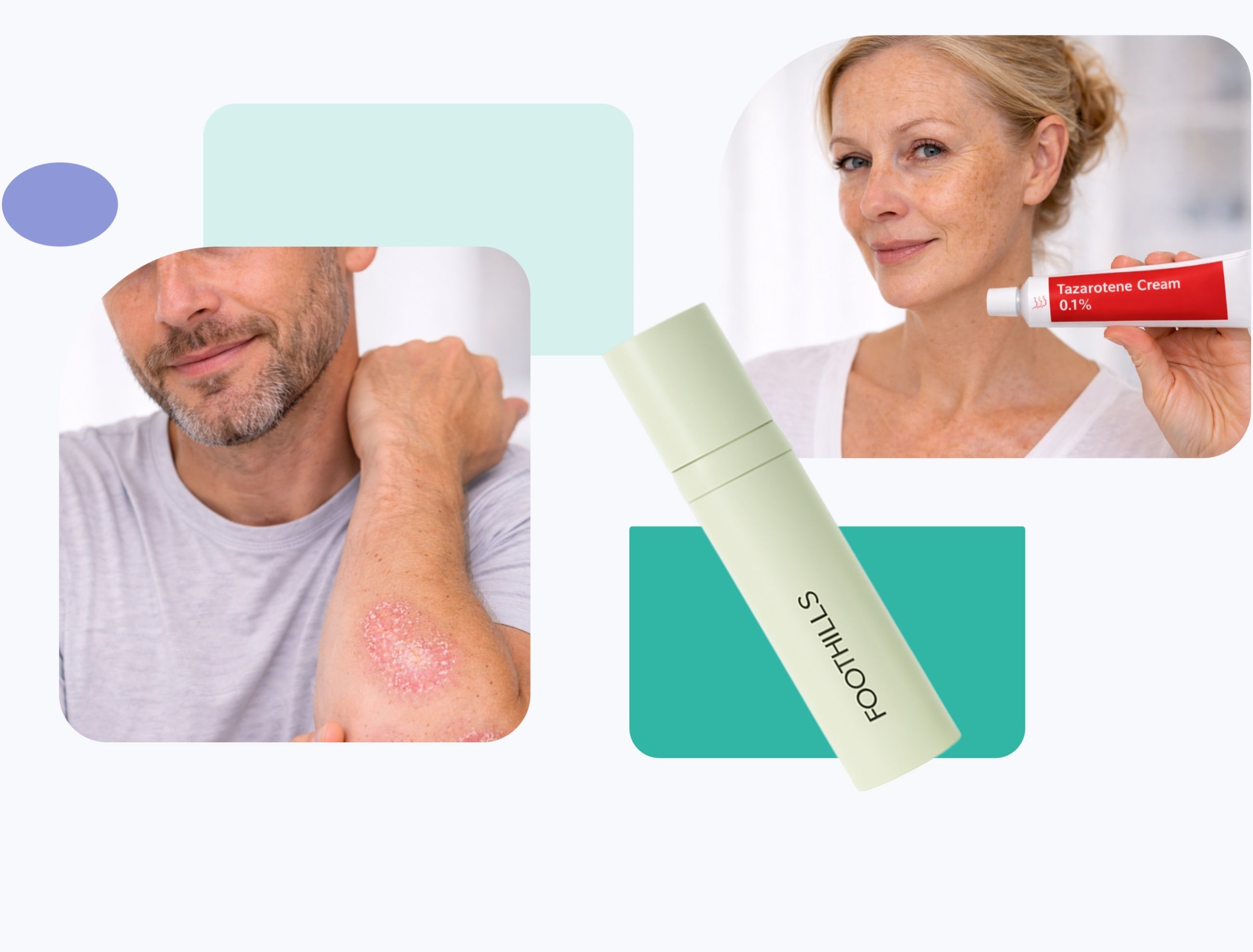 Collage showing a man with psoriasis on his arm, a woman holding a tube of tazarotene cream 0.1%, and a bottle labeled “FOOTHILLS” on a light background with abstract shapes.