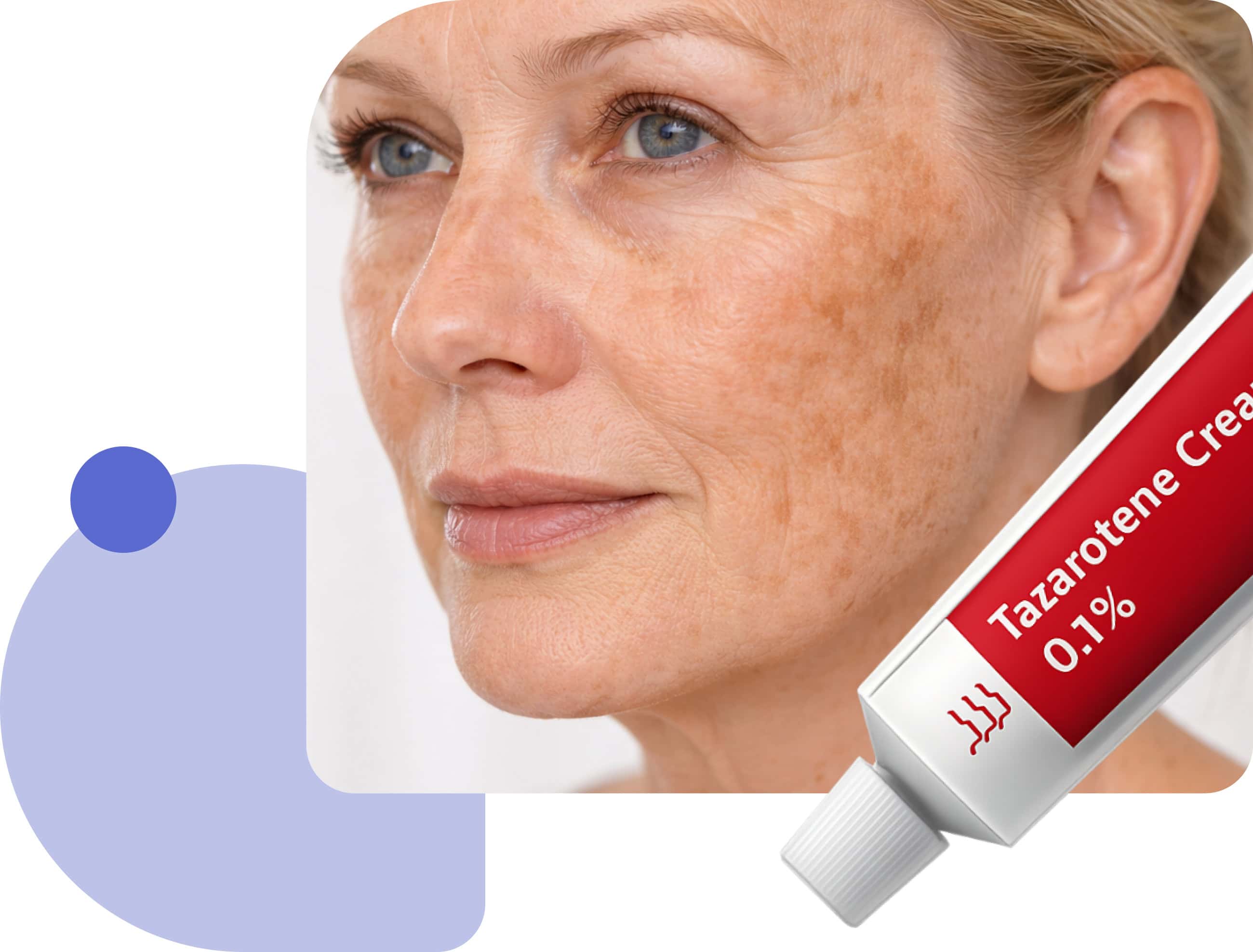 explaining tazarotene