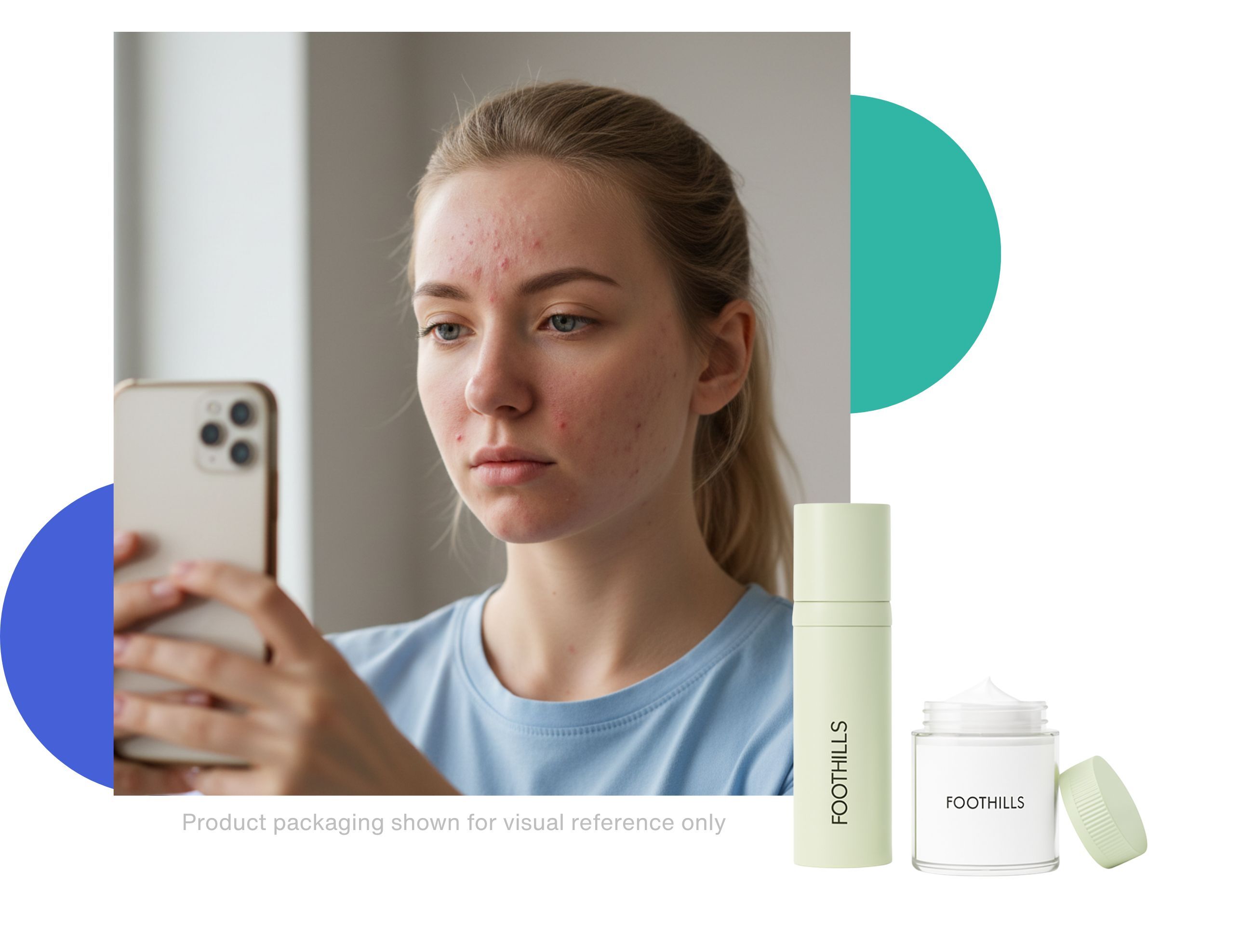 benzoyl peroxide explained girl with acne making selfie