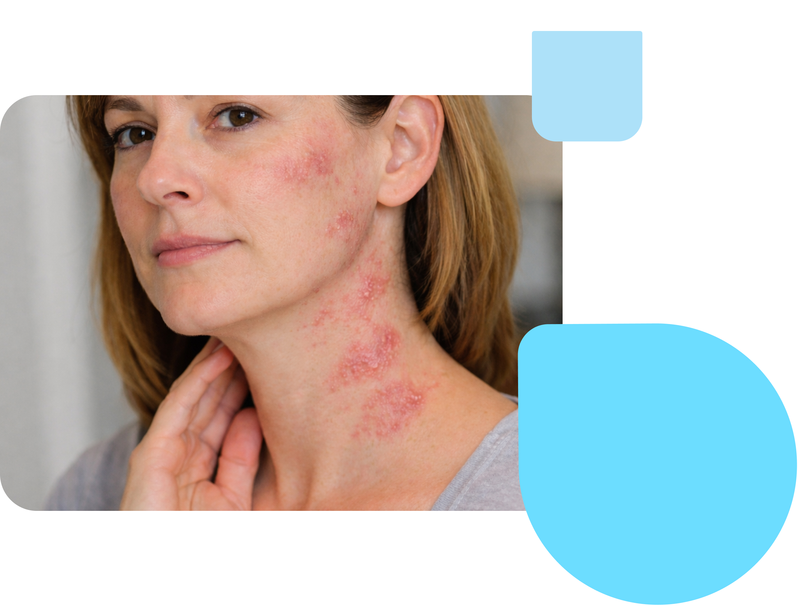 shingles treatment woman with shingles on face and neck