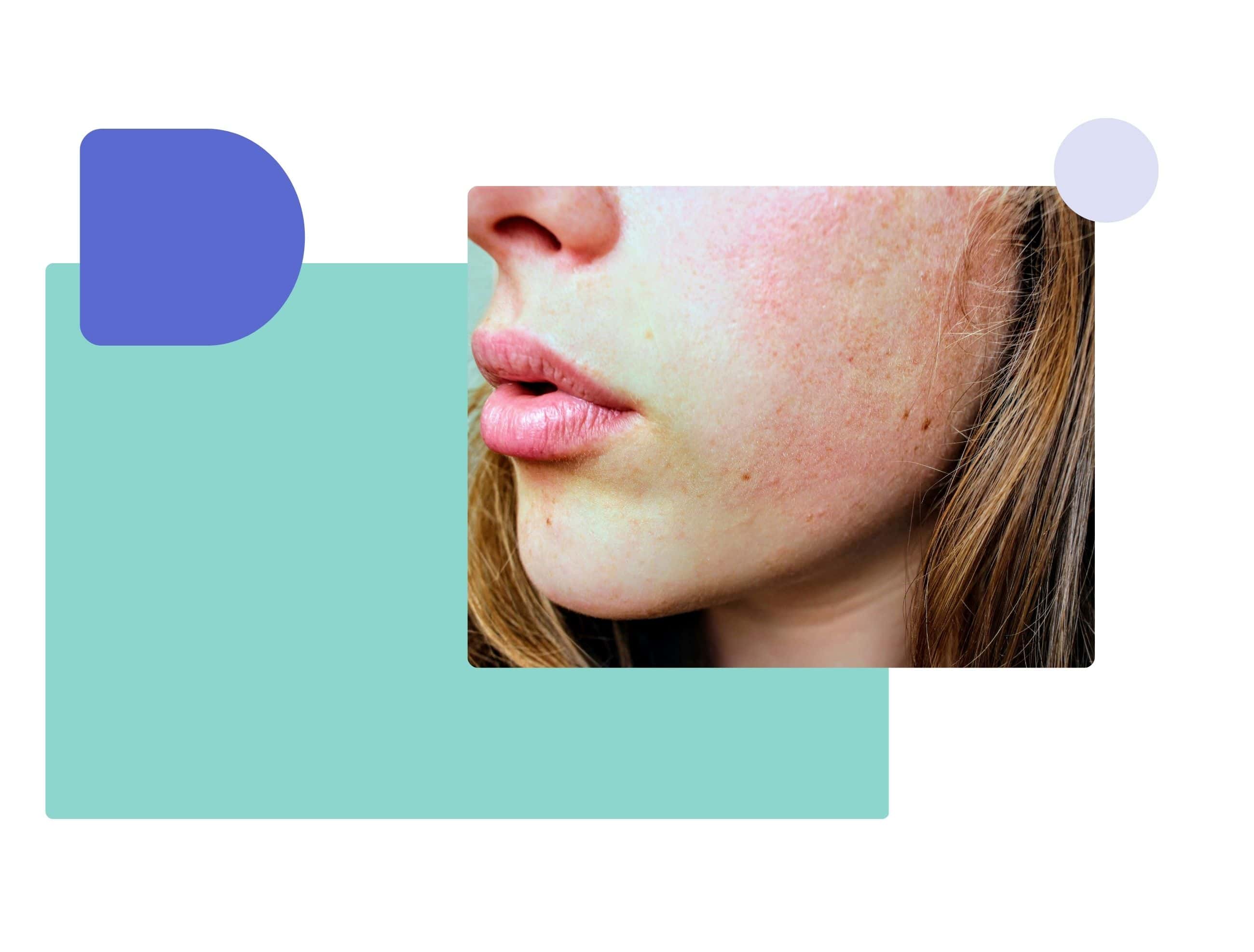 image showing side effect of using ivermectin, skin irritation on girl's face