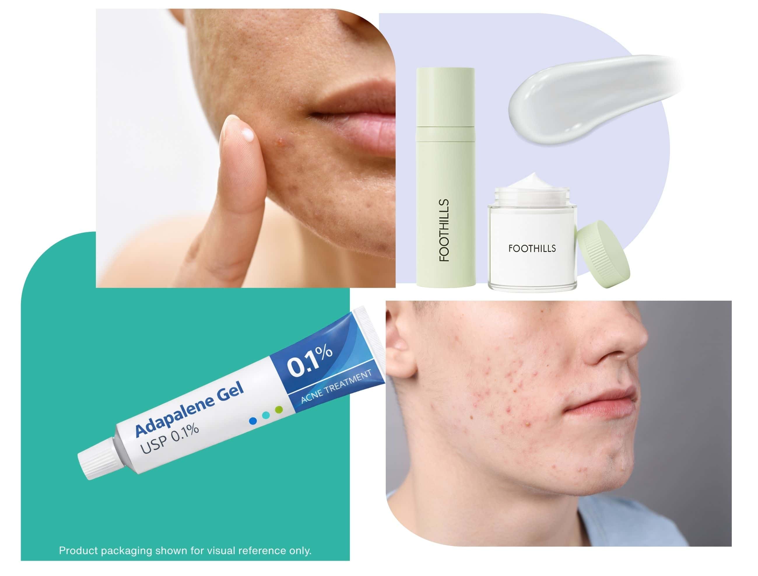 Collage illustrating adapalene for acne, showing topical treatment application, a man with facial acne, generic adapalene gel packaging for reference, and Foothills compounding medicine packaging.