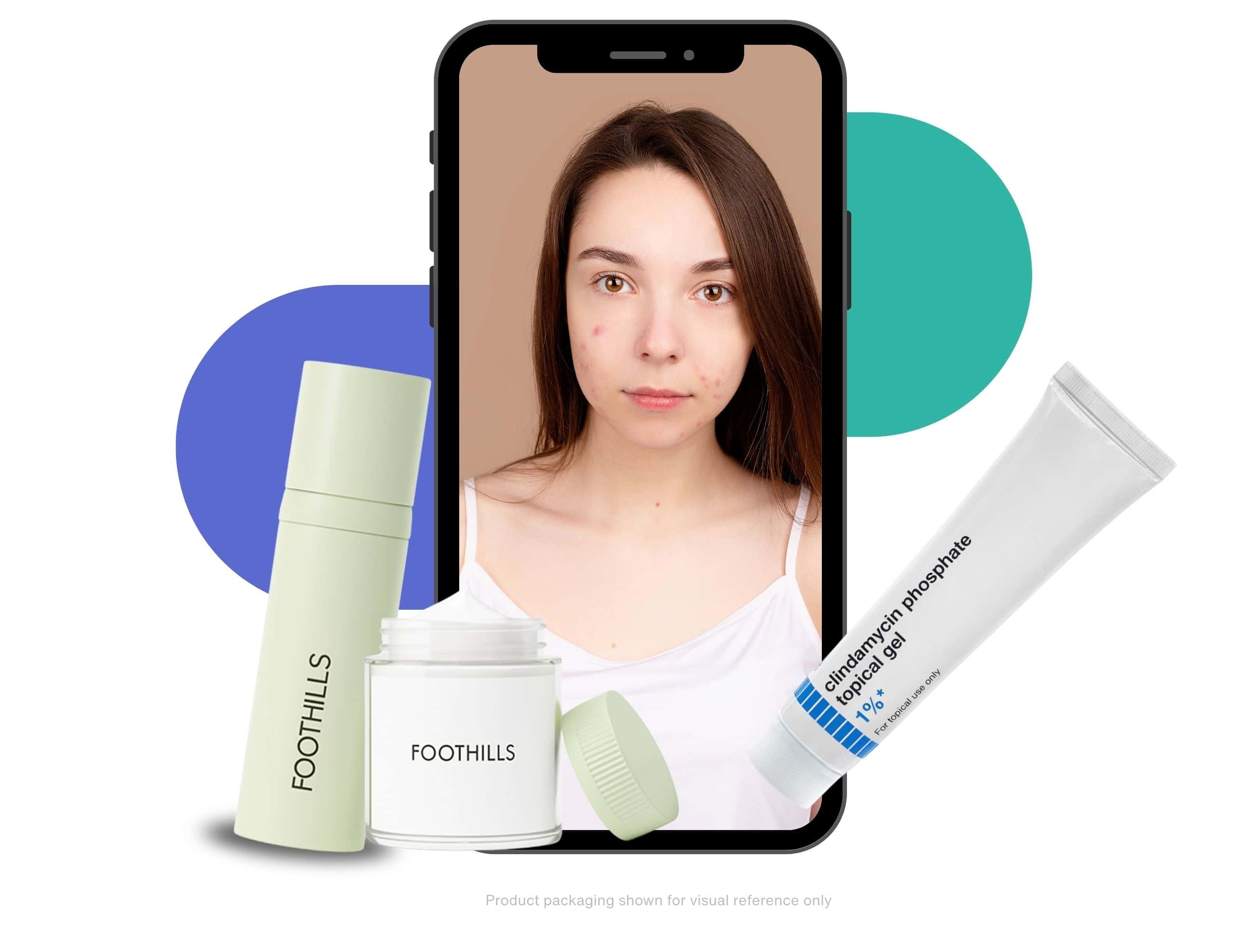 Young woman with acne shown on a smartphone screen alongside Foothills skincare products and a tube of clindamycin topical gel, illustrating online acne treatment.