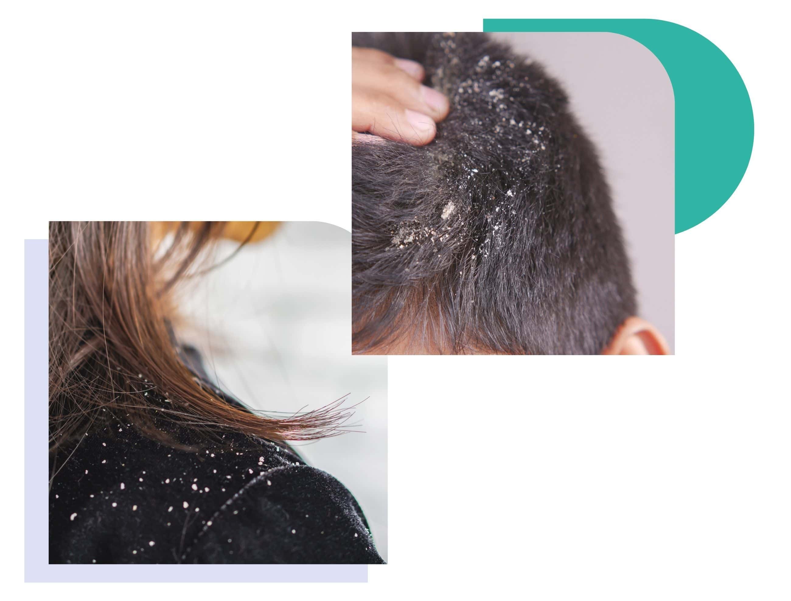 Persons with dandruff flakes on the scalp and shoulders