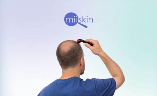 man using derma roller on scalp