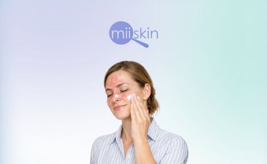 women with facial psoriasis applying cream