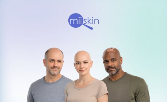 3 people with alopecia