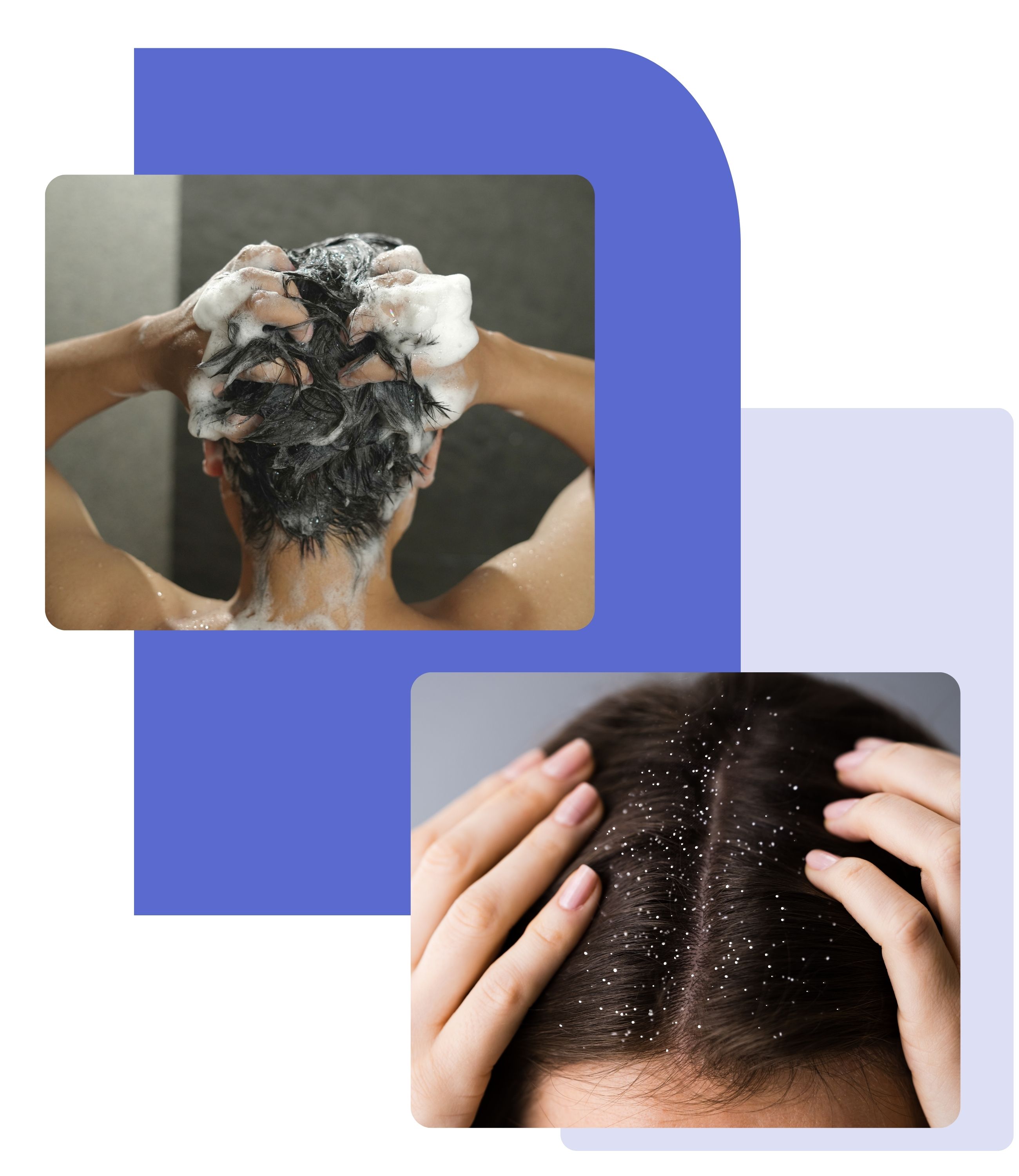 Illustration of dandruff showing a person washing their hair and visible flakes on the scalp