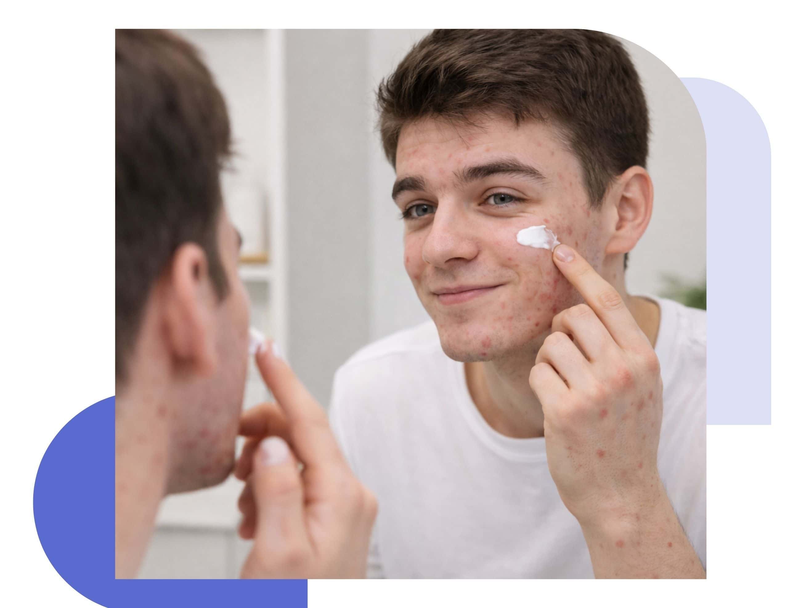 What is aklief and how it is used for acne what is aklief cream