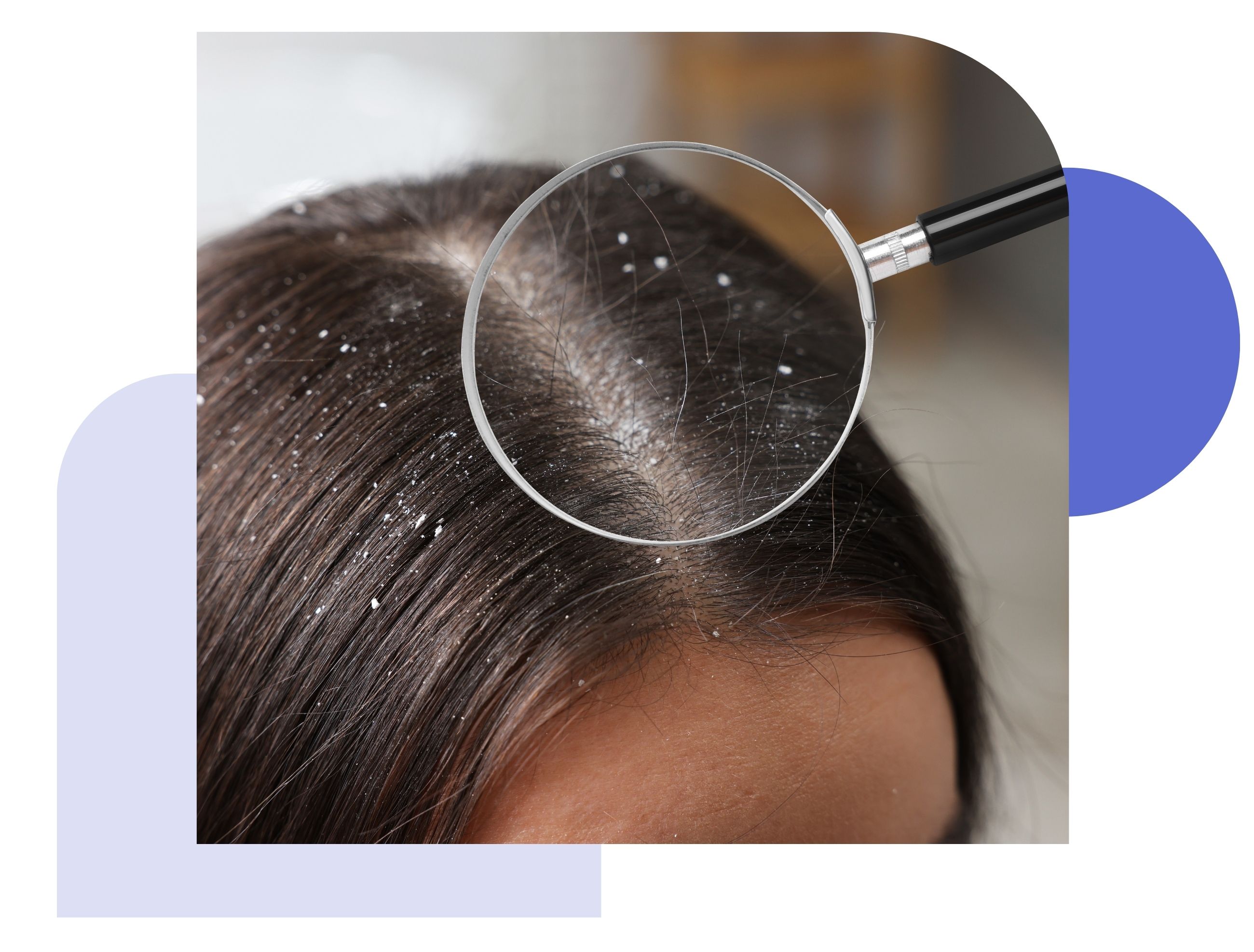 girls hair with dandruff